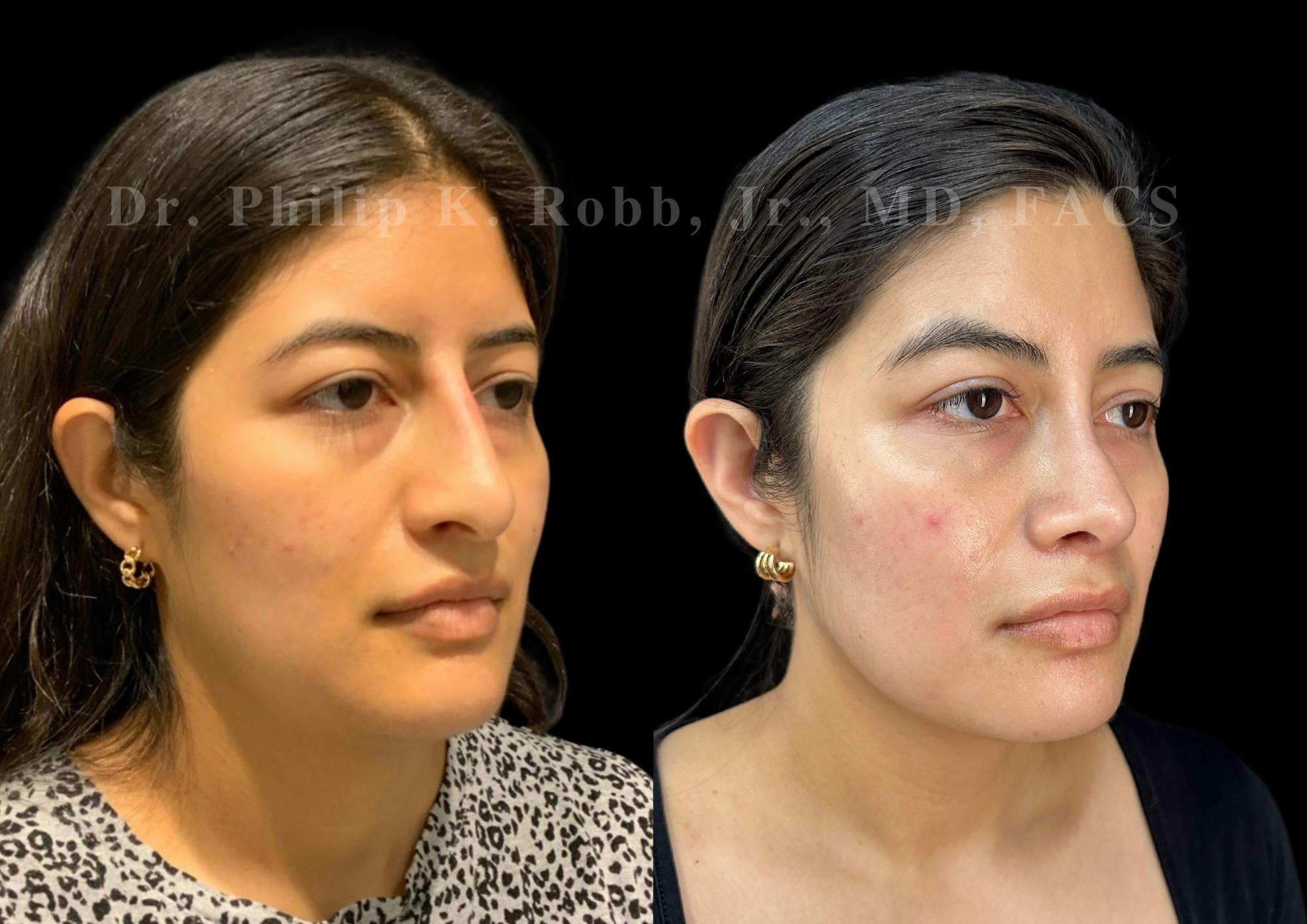 Ultrasonic Rhinoplasty Before & After Gallery - Patient 235995 - Image 2