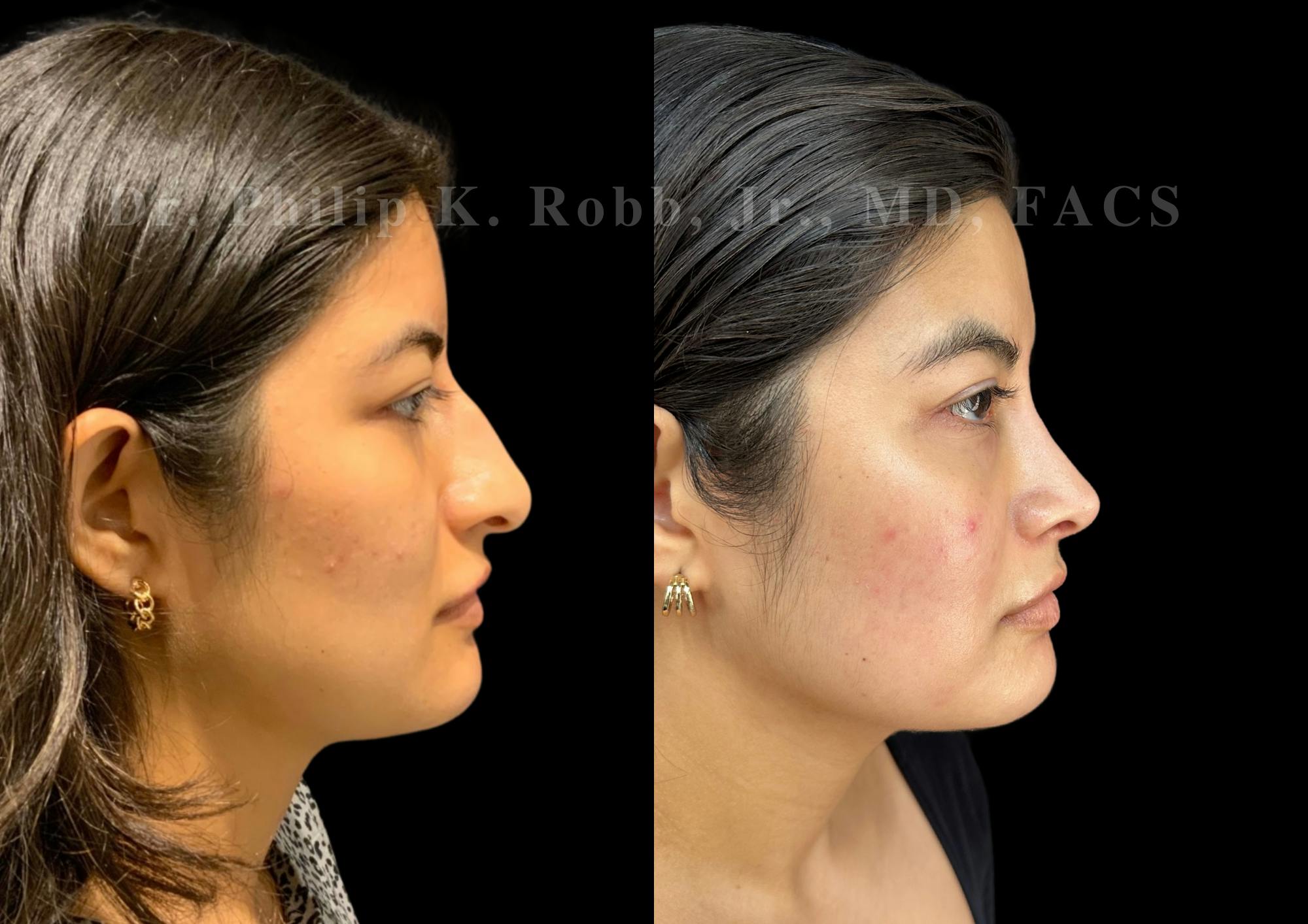 Ultrasonic Rhinoplasty Before & After Gallery - Patient 235995 - Image 1