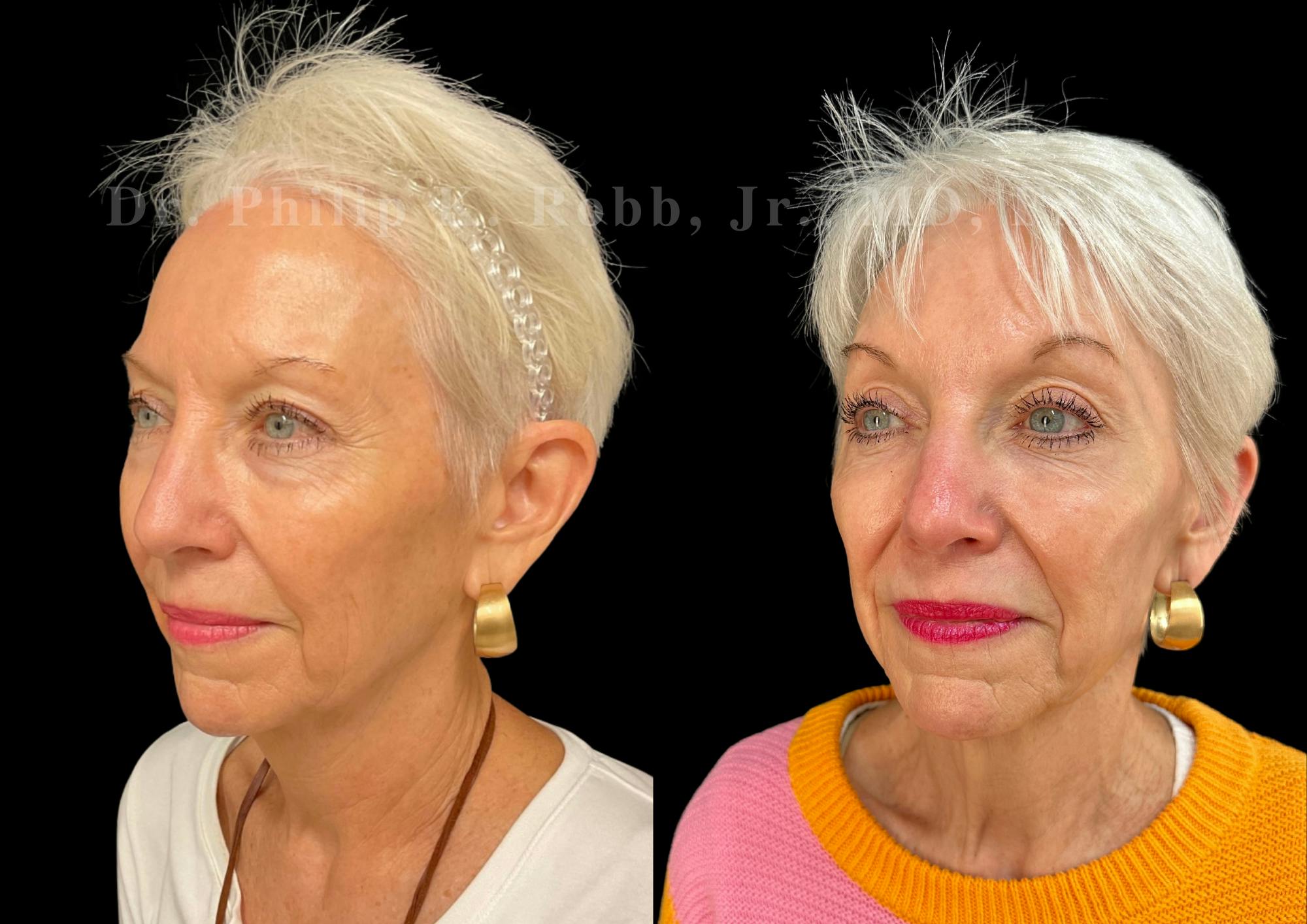 Upper Blepharoplasty Before & After Gallery - Patient 176931 - Image 2
