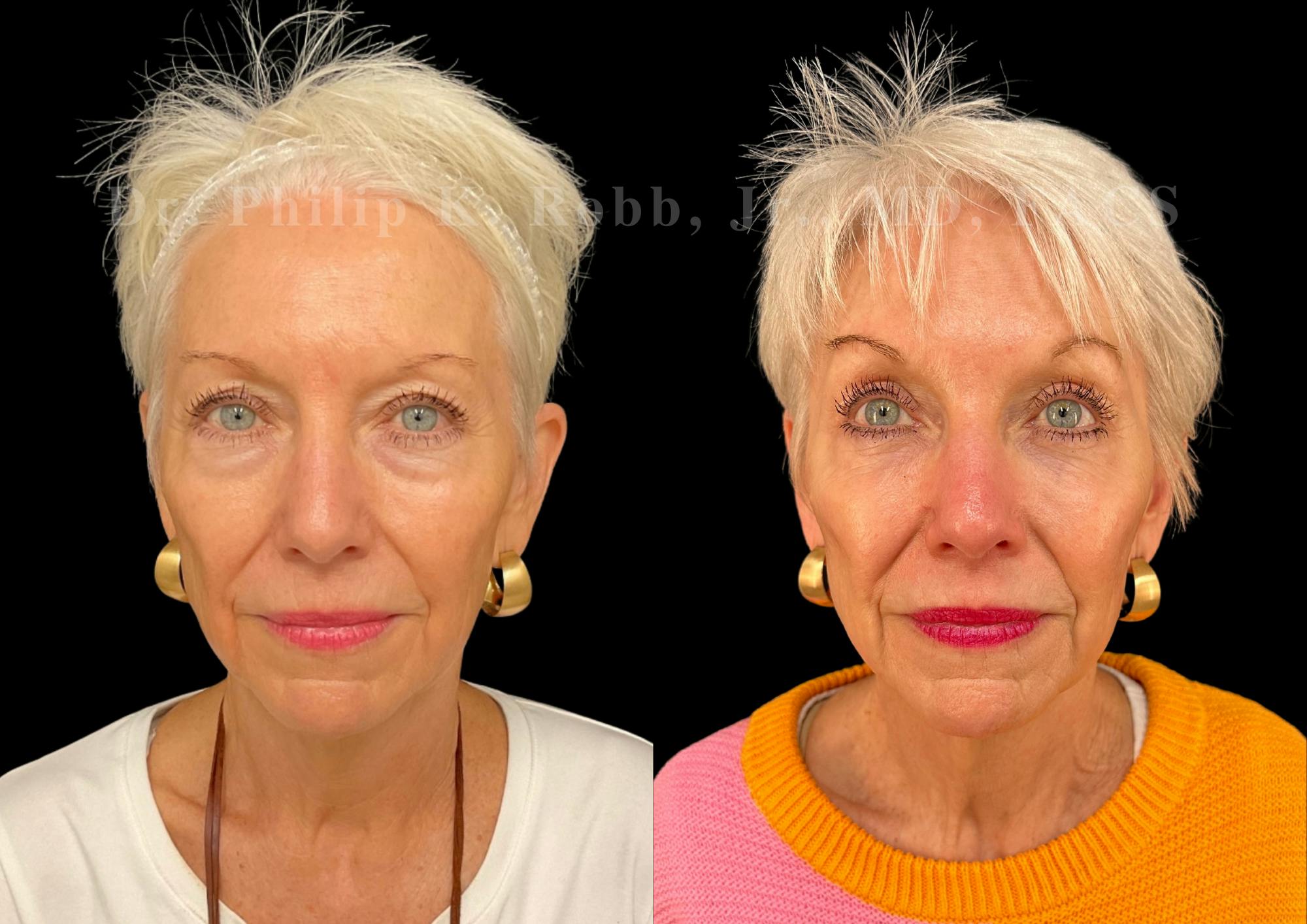 Lower Blepharoplasty Before & After Gallery - Patient 326608 - Image 1