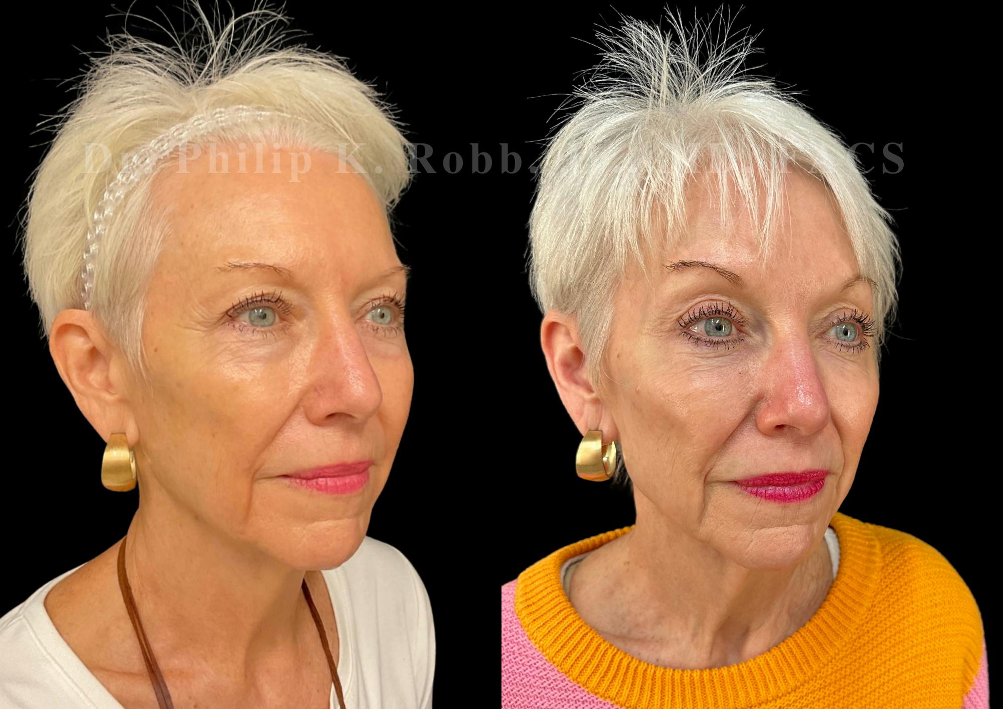 Upper Blepharoplasty Before & After Gallery - Patient 176931 - Image 3