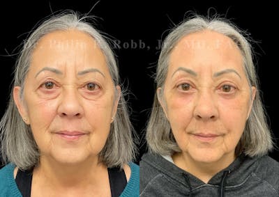 Laser Skin Resurfacing Before & After Gallery - Patient 356005 - Image 1