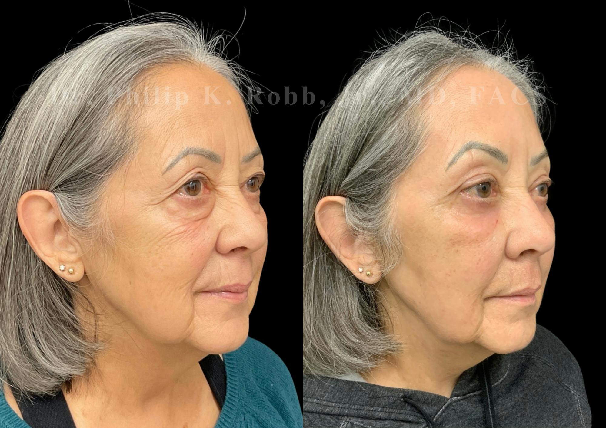 Facial Implants & Fat Transfer Before & After Gallery - Patient 225247 - Image 2
