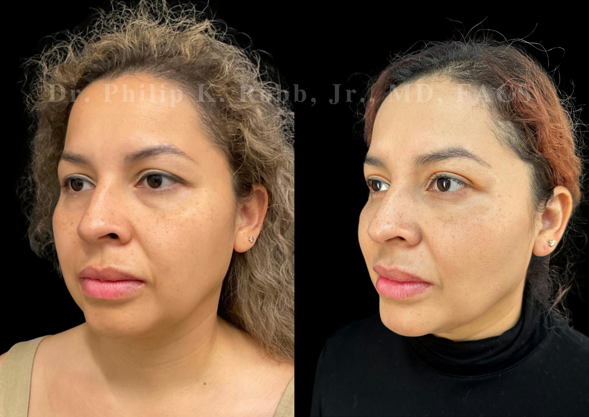 Lower Blepharoplasty Before & After Gallery - Patient 384002 - Image 3