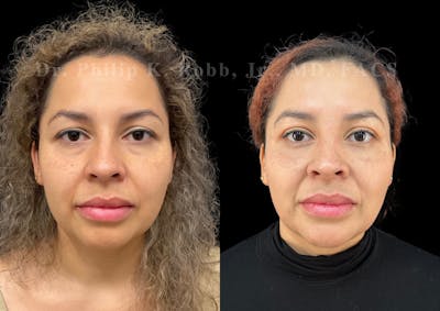 Upper Blepharoplasty Before & After Gallery - Patient 277845 - Image 1