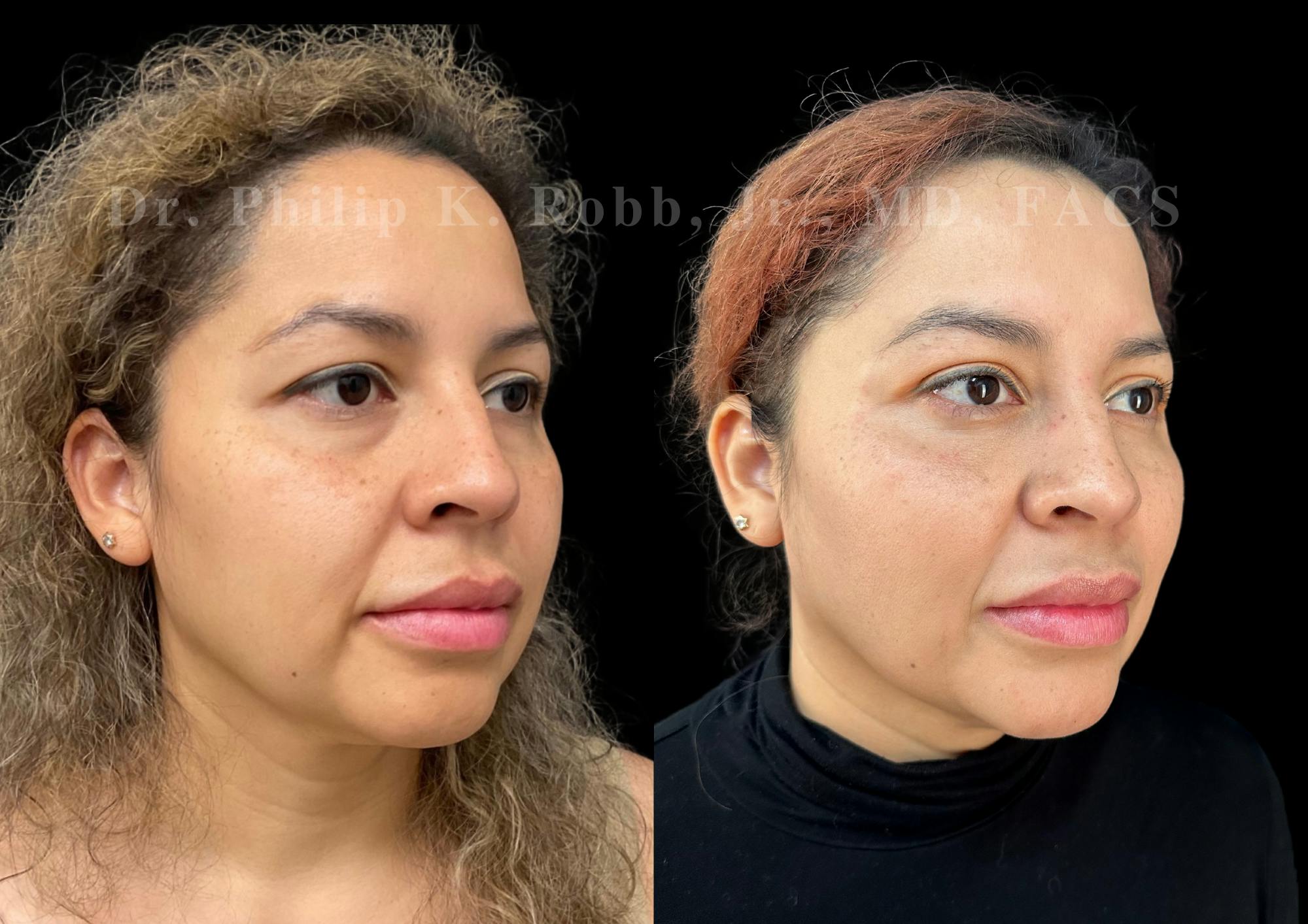 Lower Blepharoplasty Before & After Gallery - Patient 384002 - Image 2
