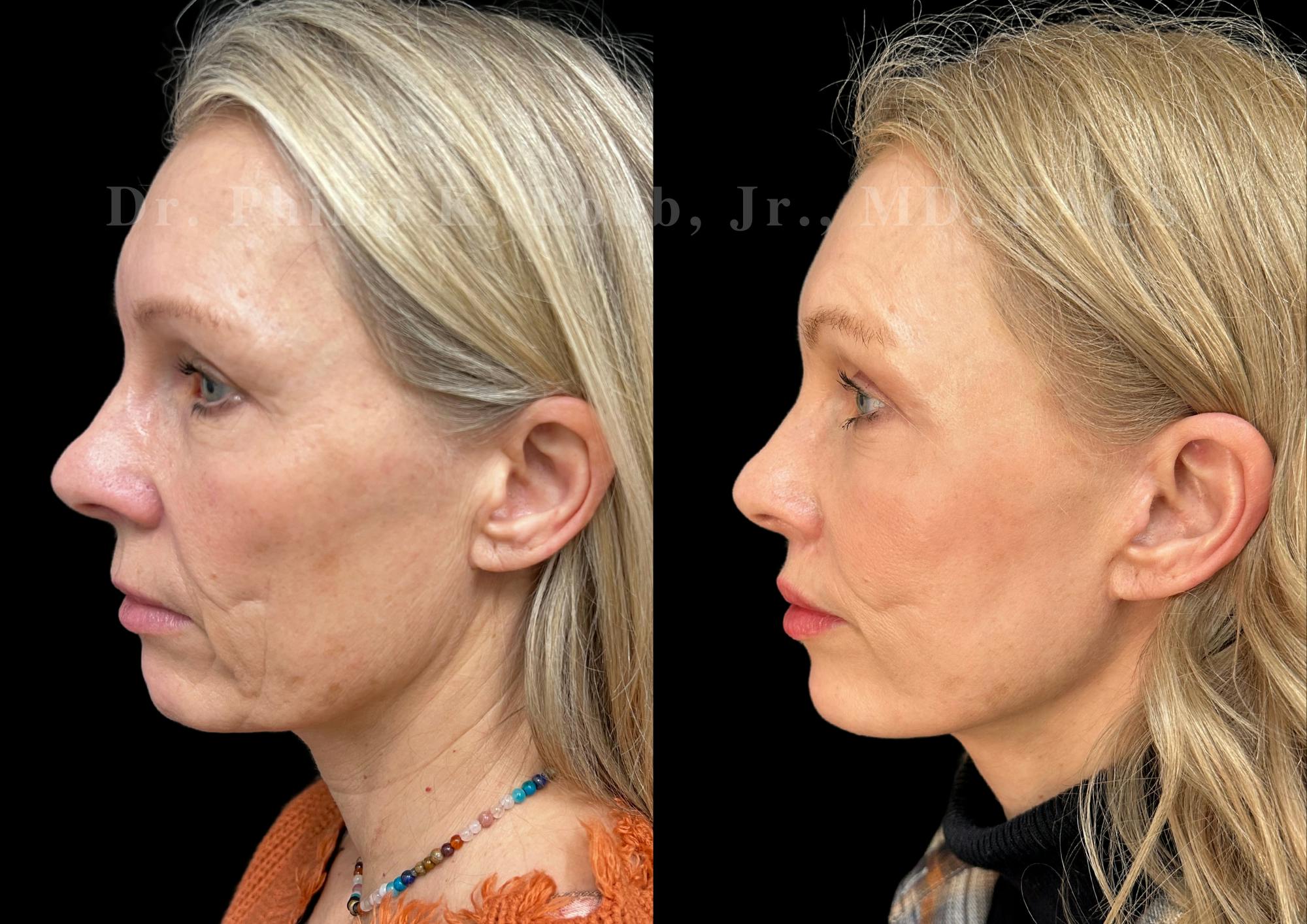 Neck Lift Before & After Gallery - Patient 270015 - Image 1