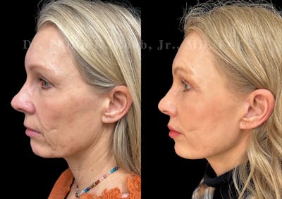 Neck Lift Before & After Gallery - Patient 270015 - Image 1