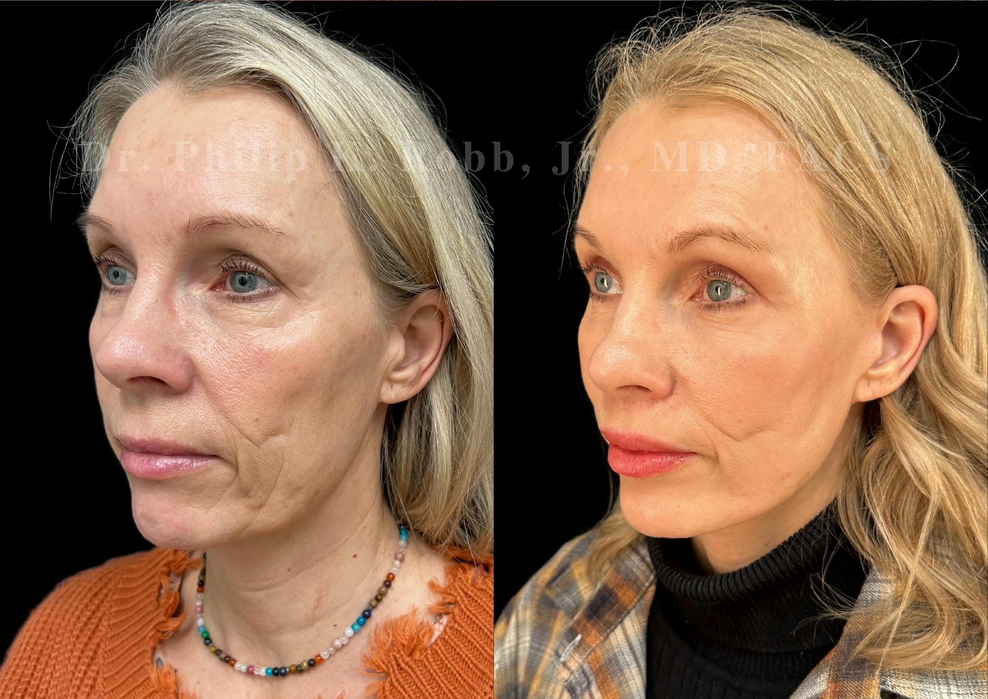 Facelift Before & After Gallery - Patient 105437 - Image 1