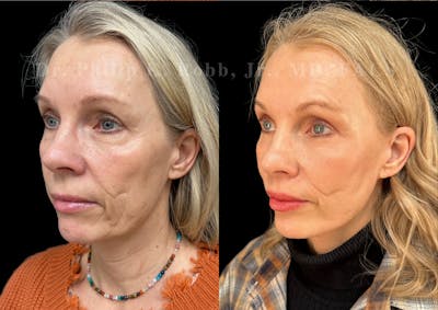 Facelift Before & After Gallery - Patient 105437 - Image 1