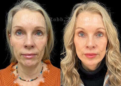 Upper Blepharoplasty Before & After Gallery - Patient 115640 - Image 1