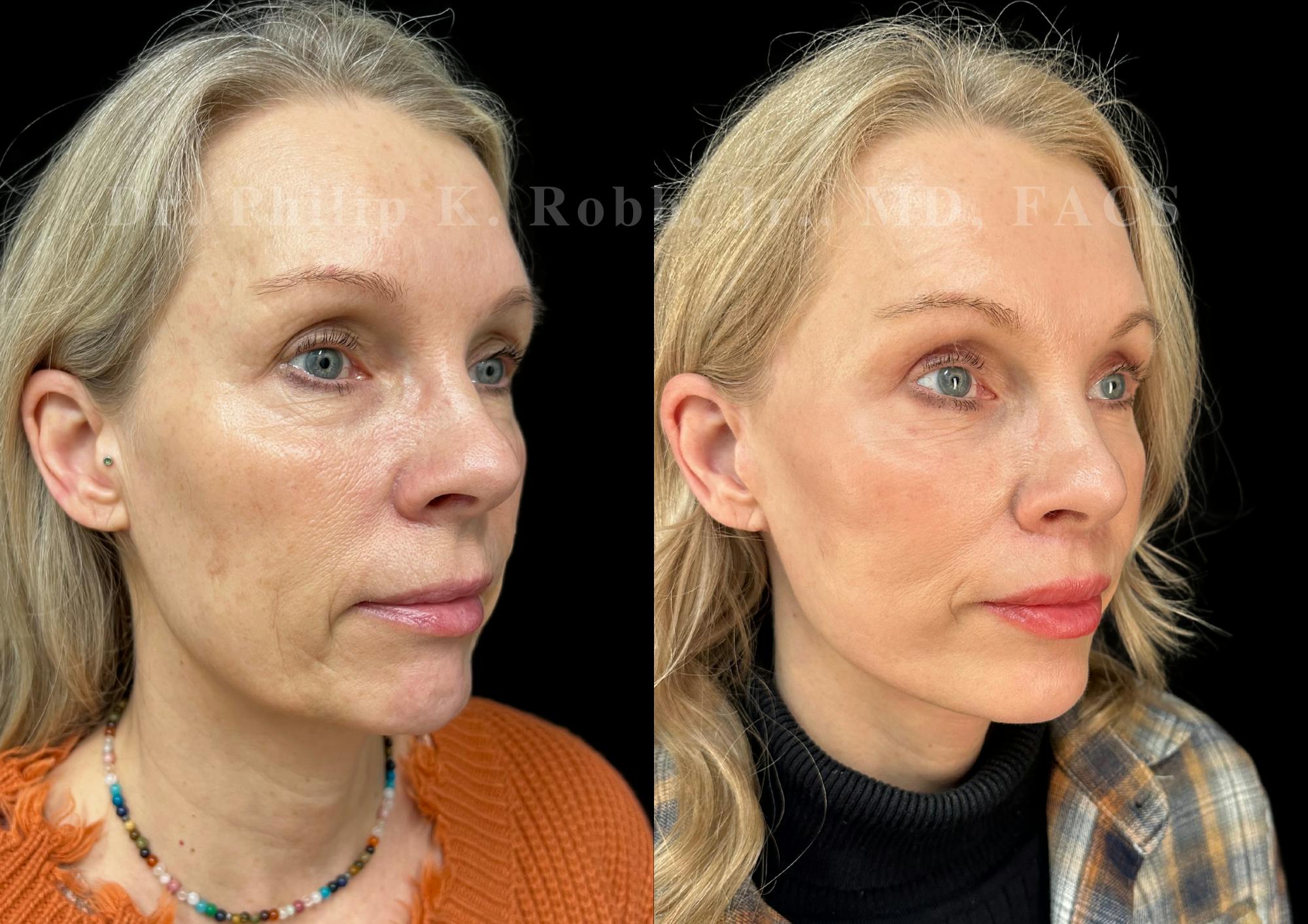 Upper Blepharoplasty Before & After Gallery - Patient 115640 - Image 2