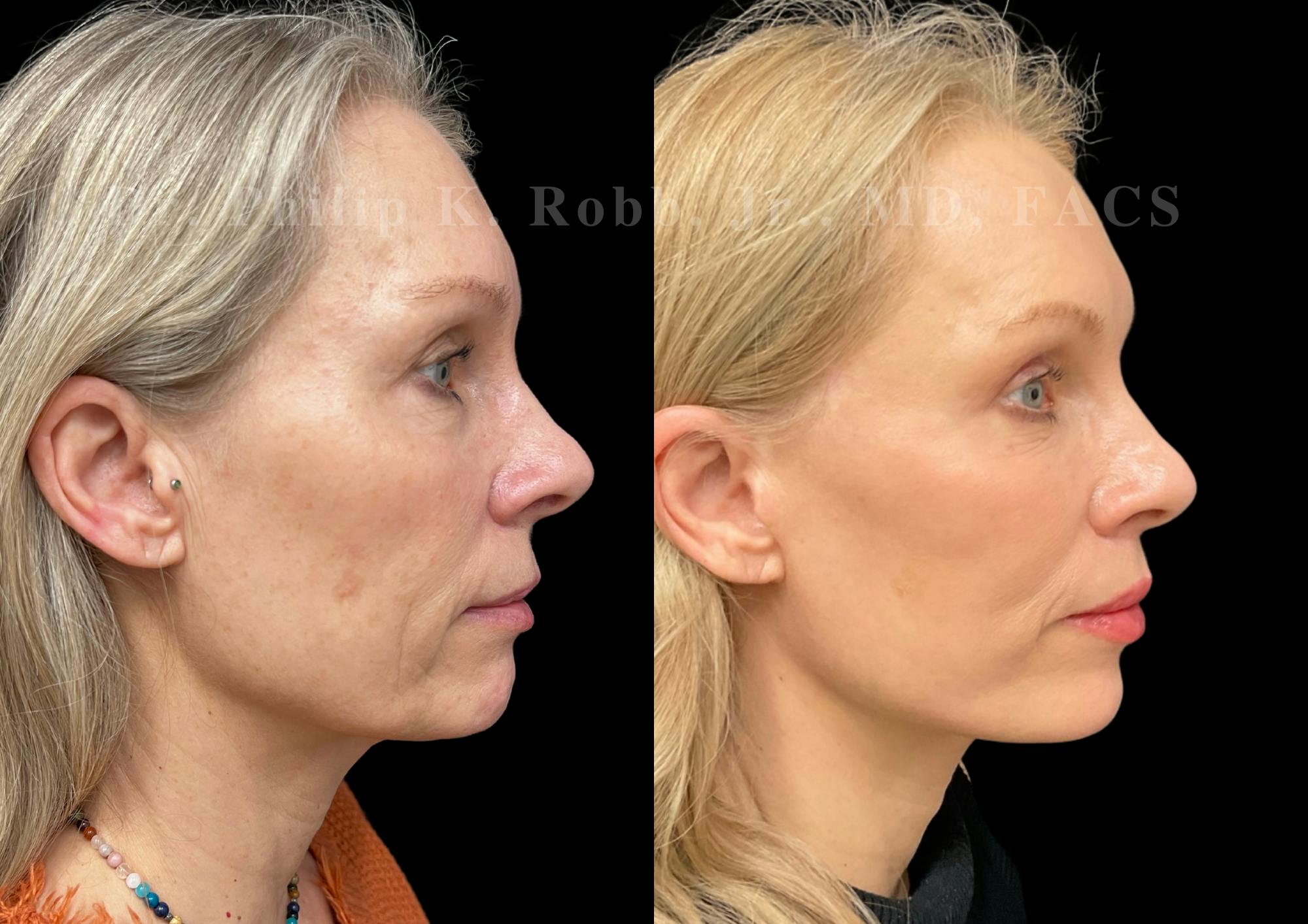 Neck Lift Before & After Gallery - Patient 270015 - Image 5