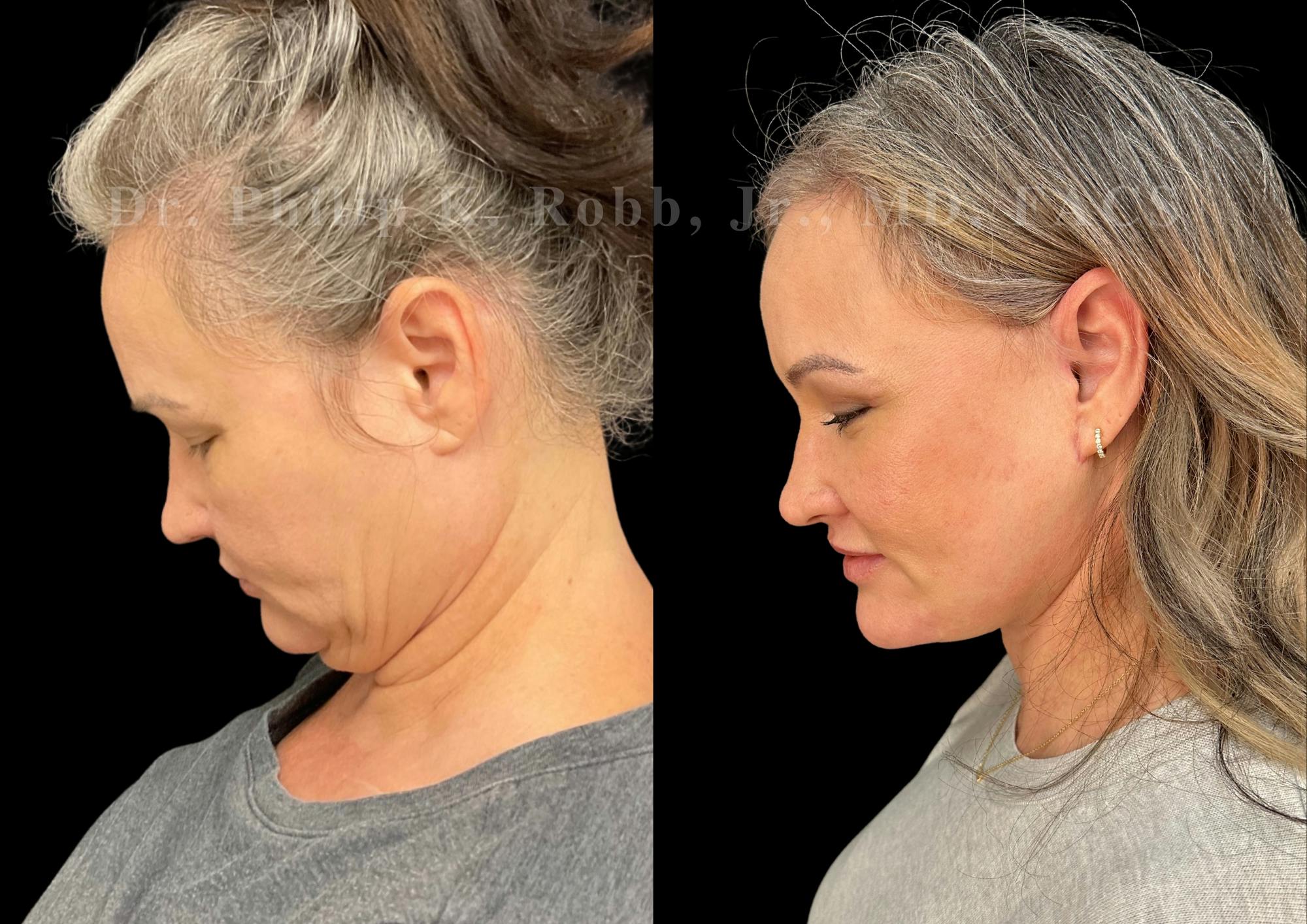 Laser Skin Resurfacing Before & After Gallery - Patient 322656 - Image 7