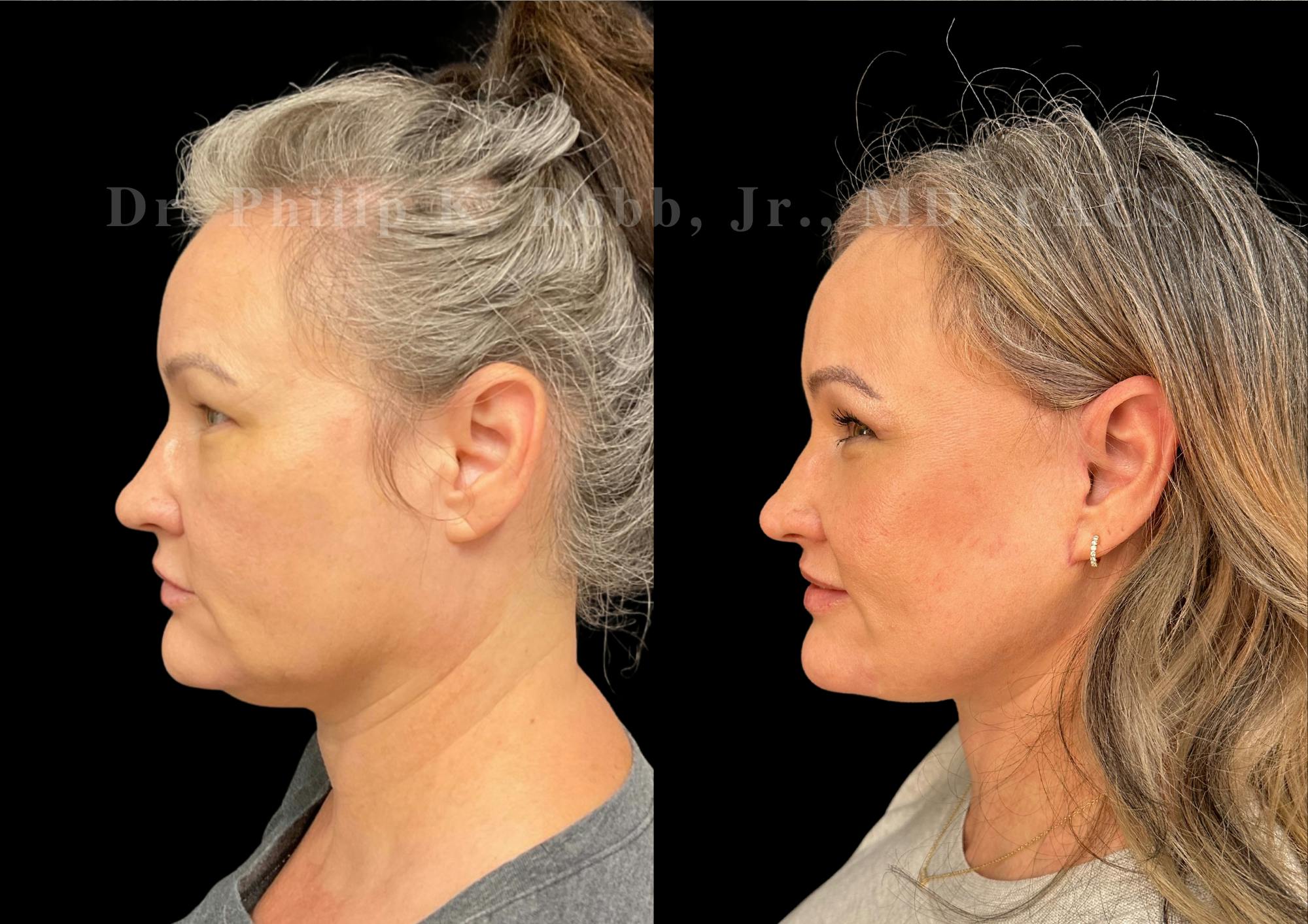 Fat Transfer Before & After Gallery - Patient 327026 - Image 6