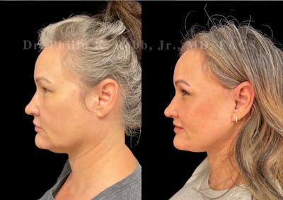 Neck Lift Before & After Gallery - Patient 137079 - Image 1