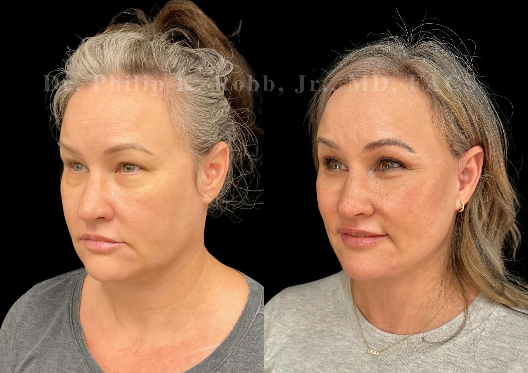 Lower Blepharoplasty Before & After Gallery - Patient 101830 - Image 5