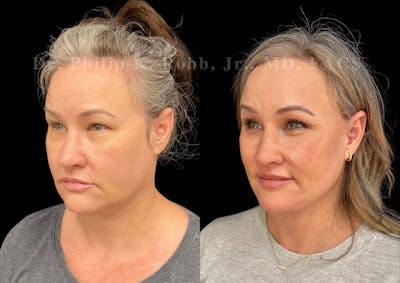 Facelift Before & After Gallery - Patient 381777 - Image 1