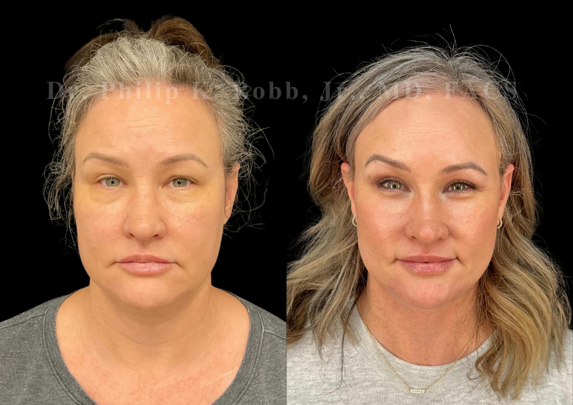 Facelift Before & After Gallery - Patient 381777 - Image 4