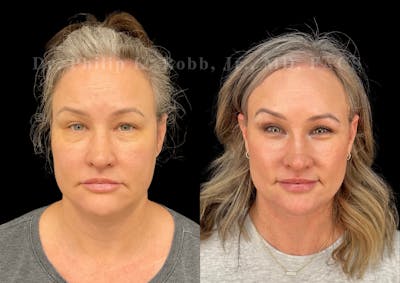 Buccal Fat Reduction Before & After Gallery - Patient 148210 - Image 1
