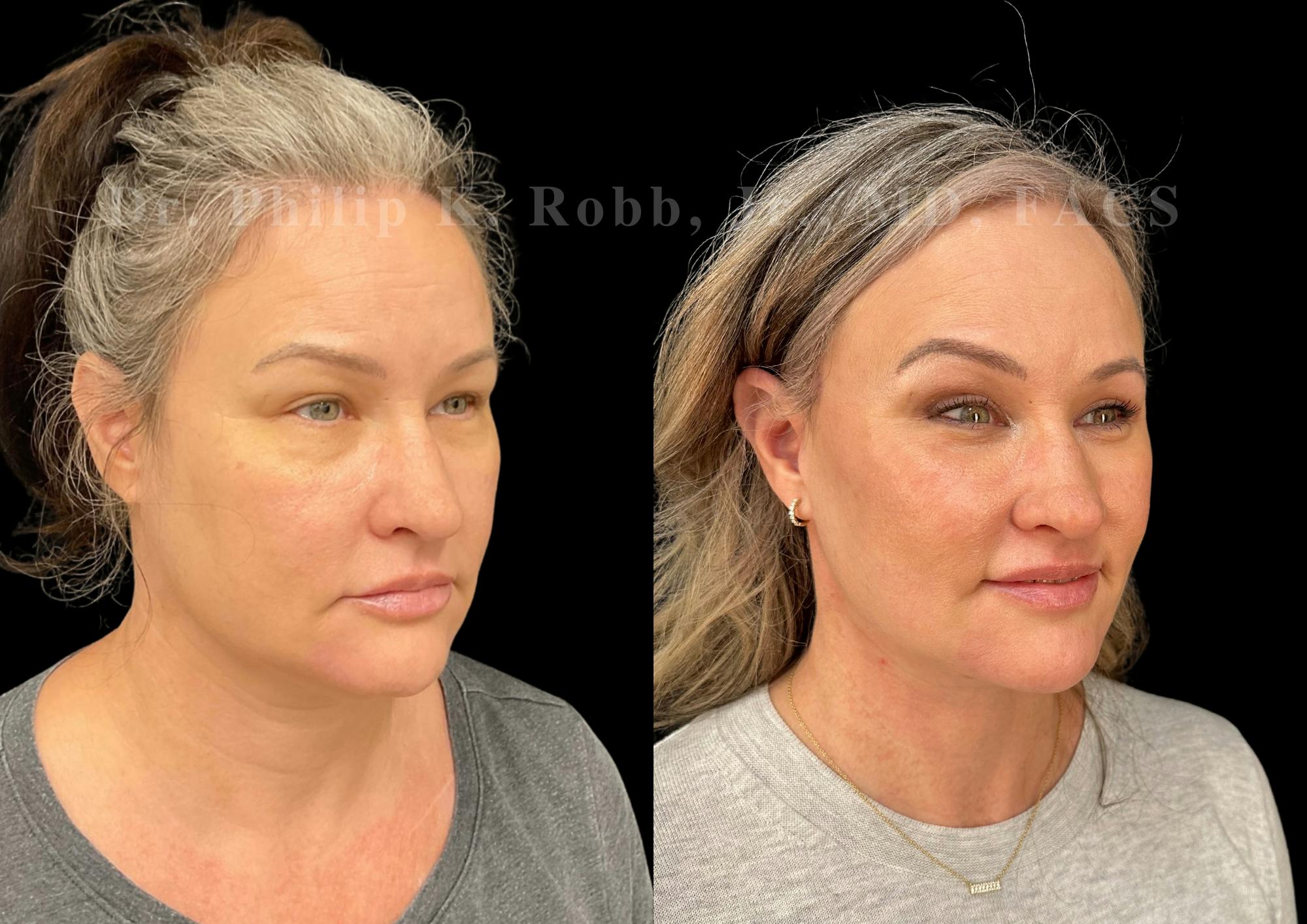 Laser Skin Resurfacing Before & After Gallery - Patient 322656 - Image 4