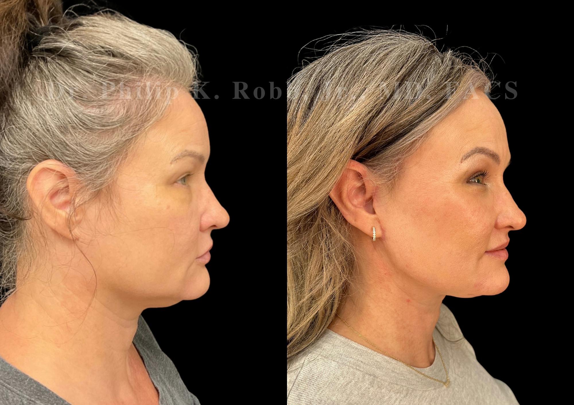Fat Transfer Before & After Gallery - Patient 327026 - Image 3