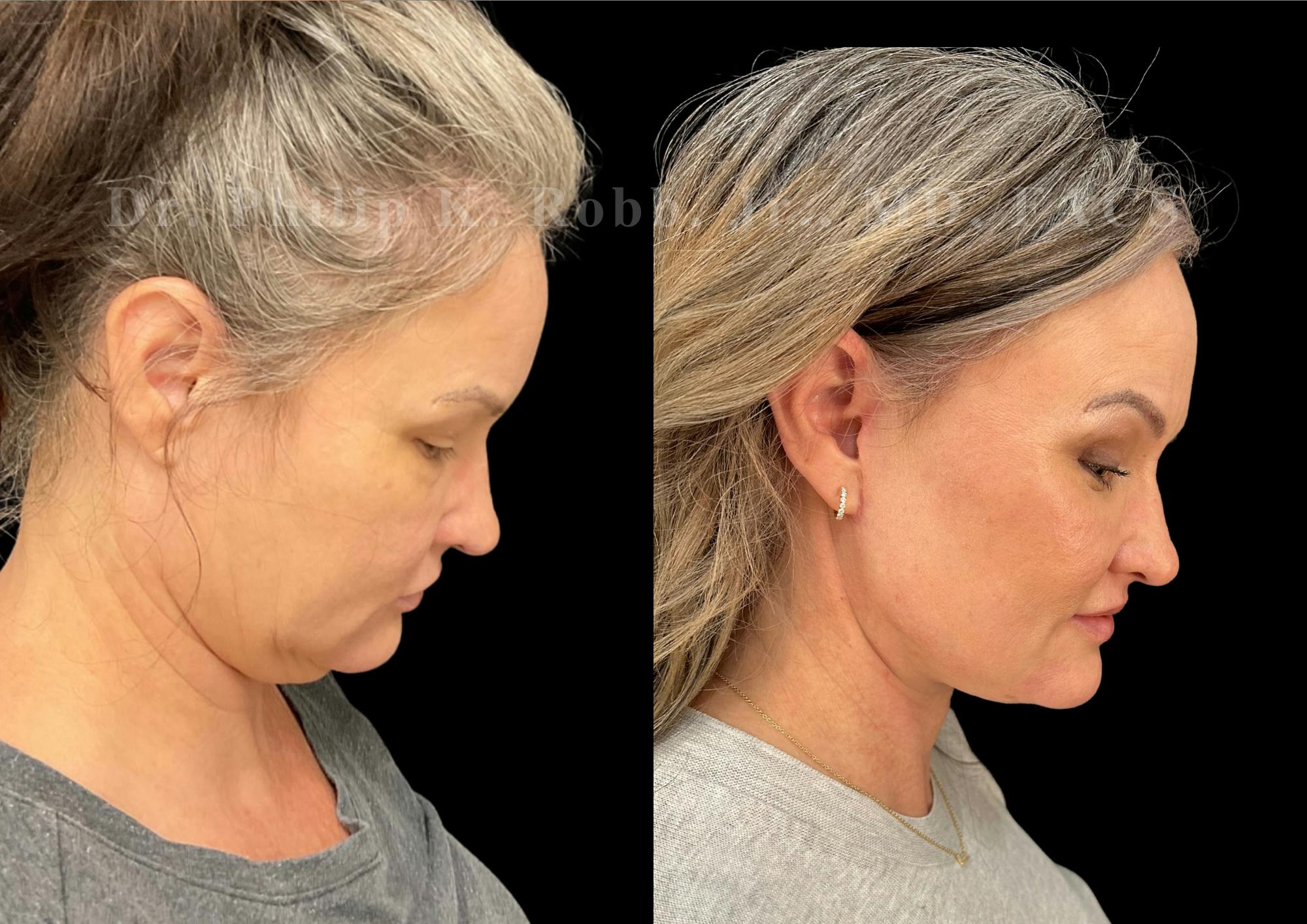 Laser Skin Resurfacing Before & After Gallery - Patient 322656 - Image 2