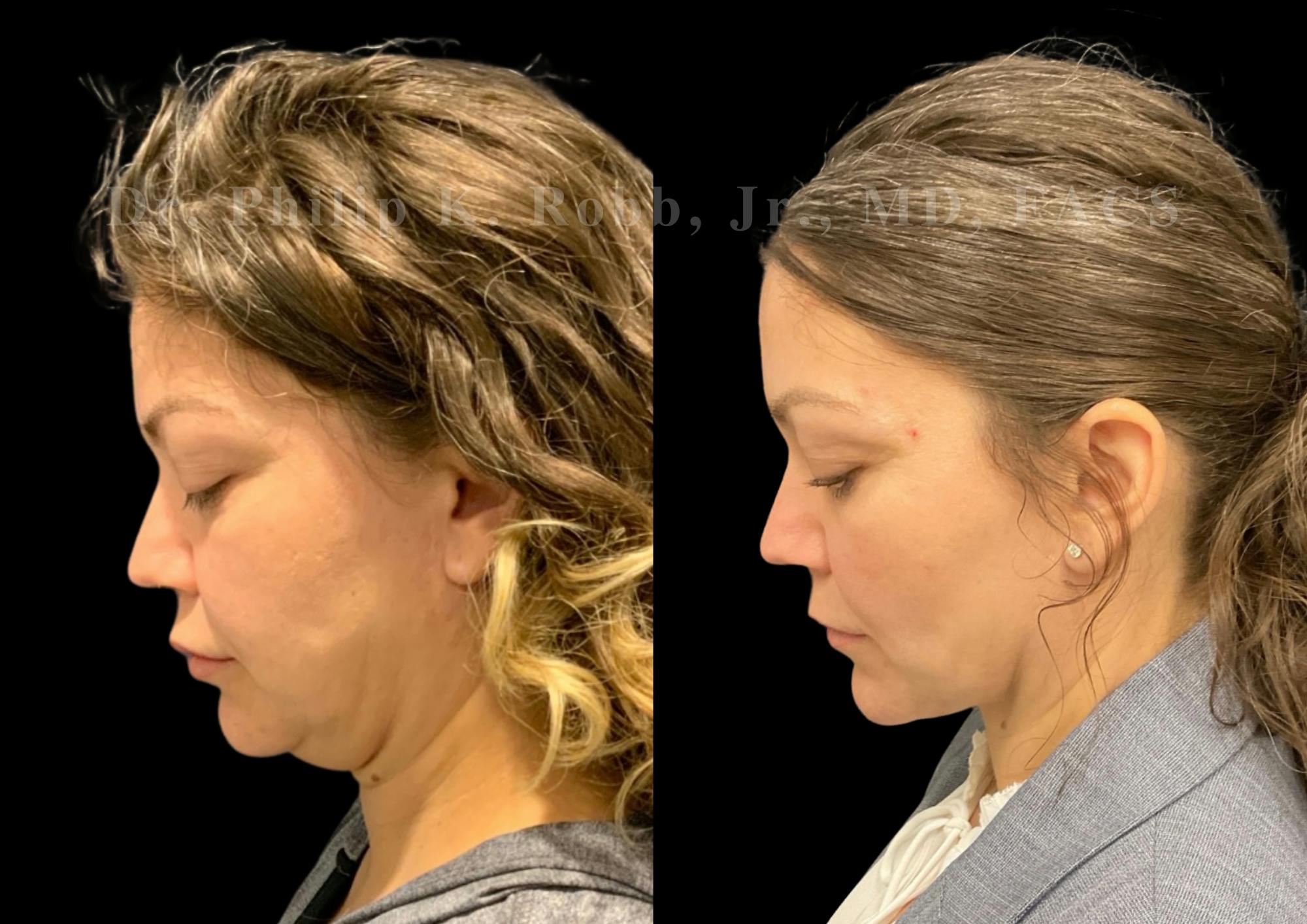 Fat Transfer Before & After Gallery - Patient 176620 - Image 7