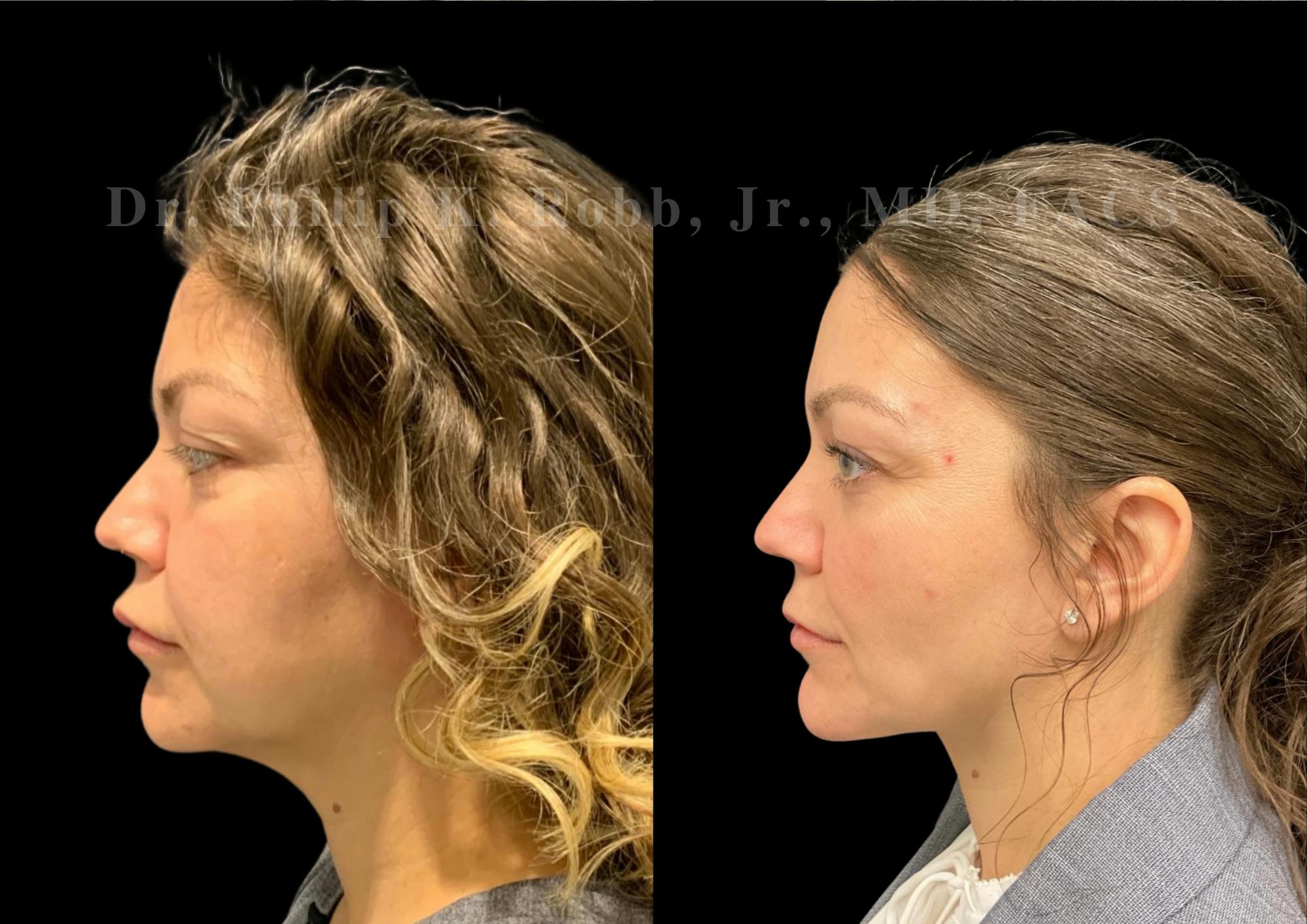 Fat Transfer Before & After Gallery - Patient 176620 - Image 6