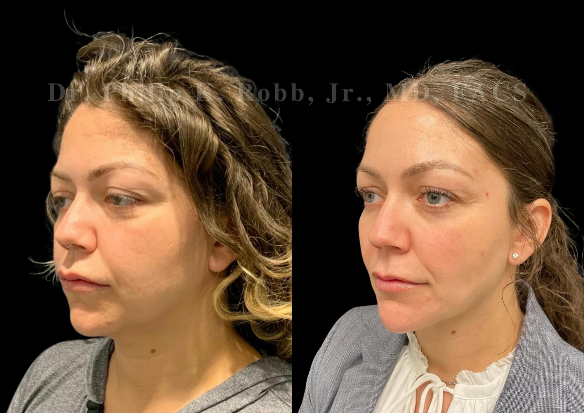 Chin Augmentation Before & After Gallery - Patient 201367 - Image 3