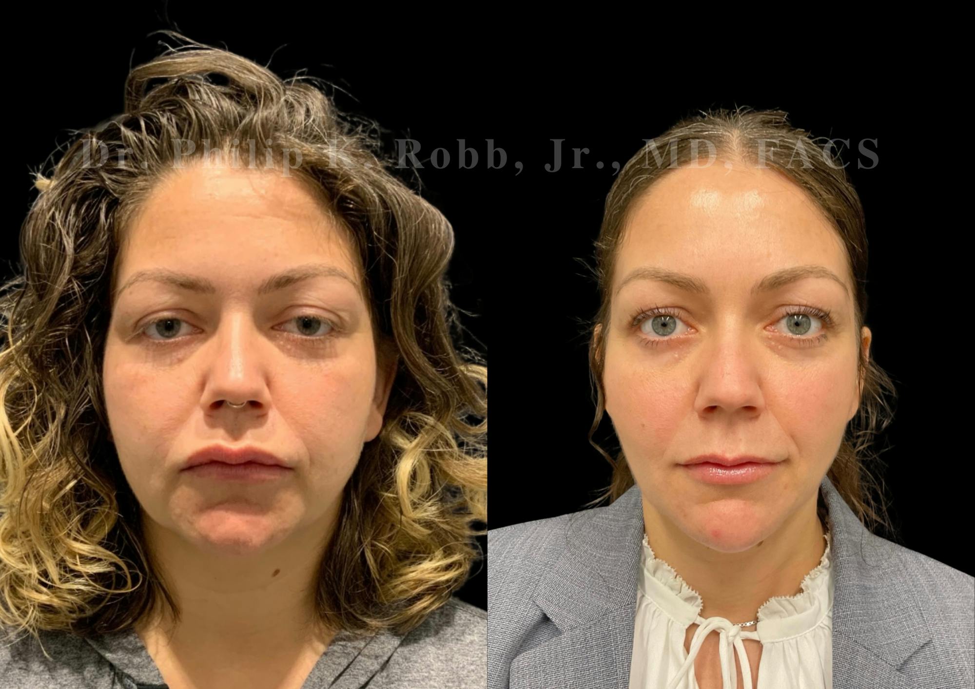 Fat Transfer Before & After Gallery - Patient 176620 - Image 1