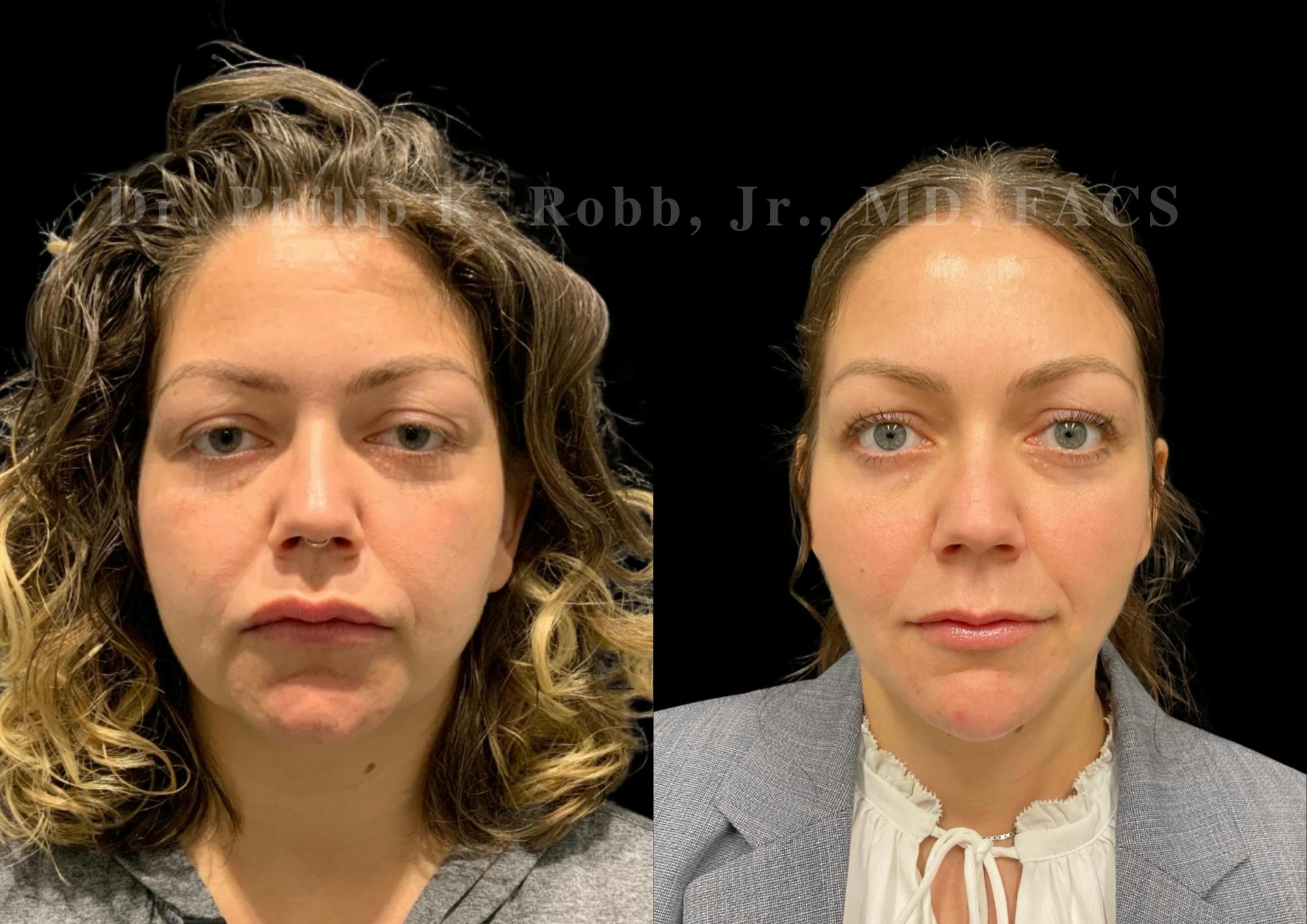 Buccal Fat Reduction Before & After Gallery - Patient 387508 - Image 1