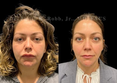 Buccal Fat Reduction Before & After Gallery - Patient 387508 - Image 1