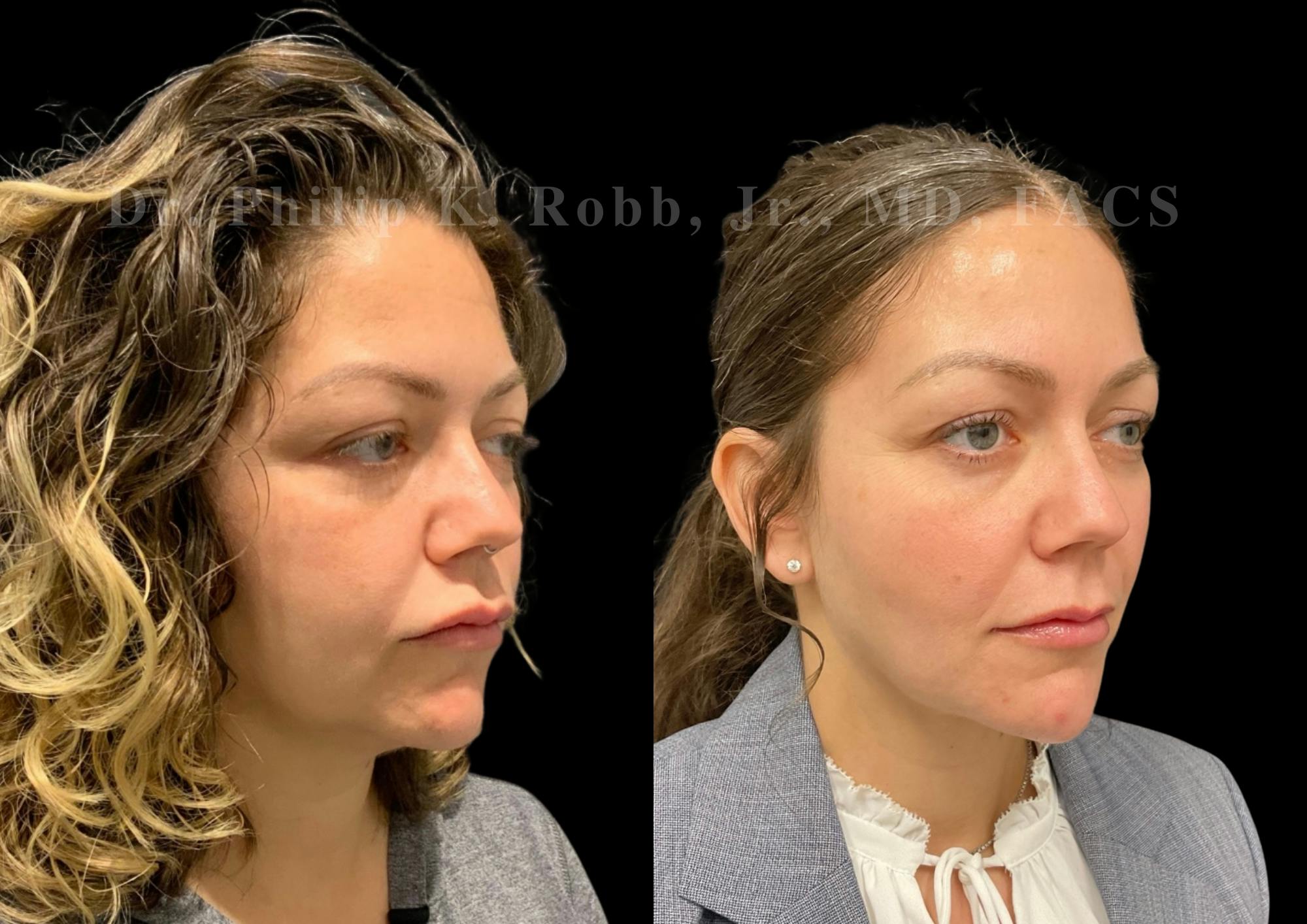 Fat Transfer Before & After Gallery - Patient 176620 - Image 4