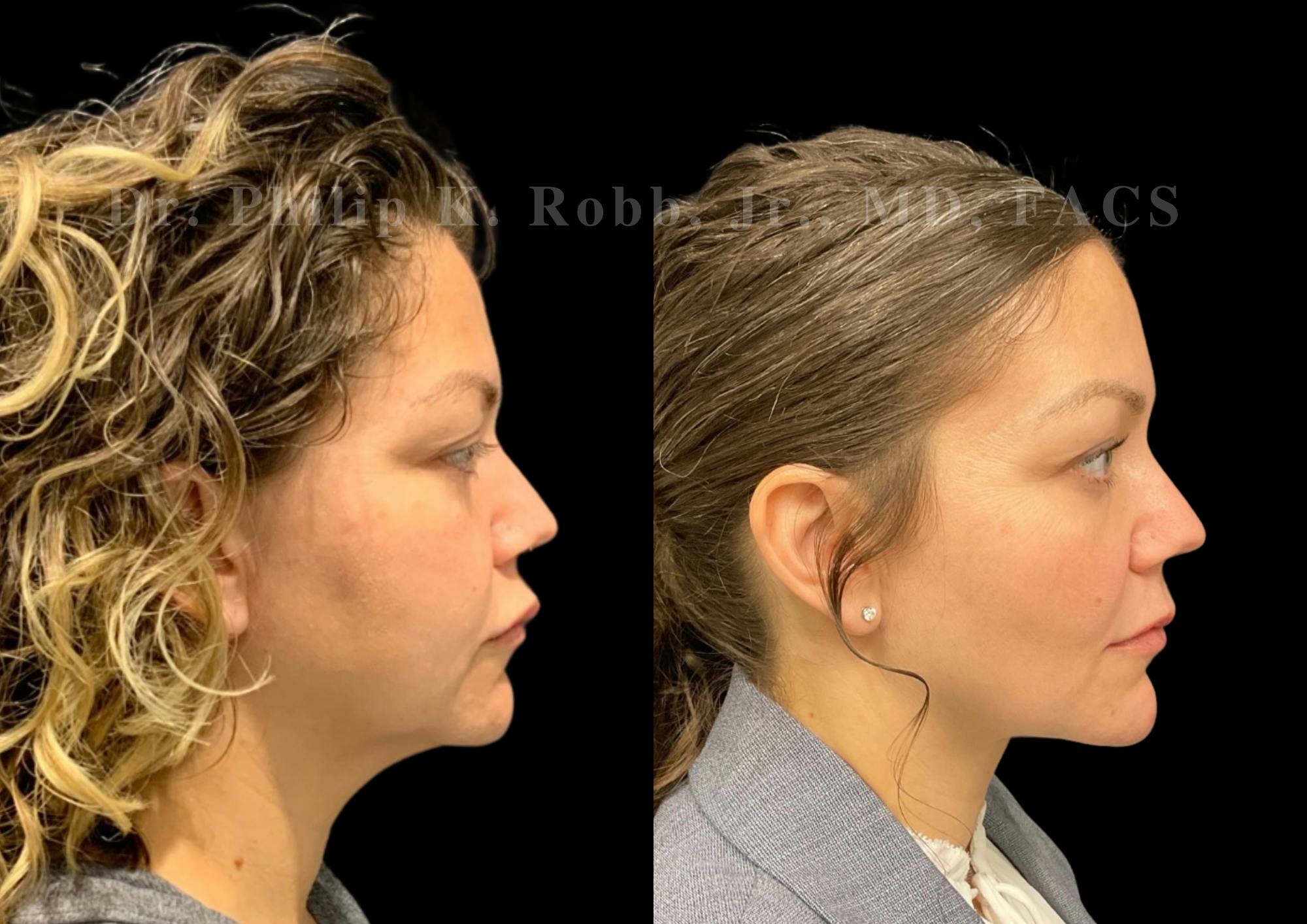 Fat Transfer Before & After Gallery - Patient 176620 - Image 3