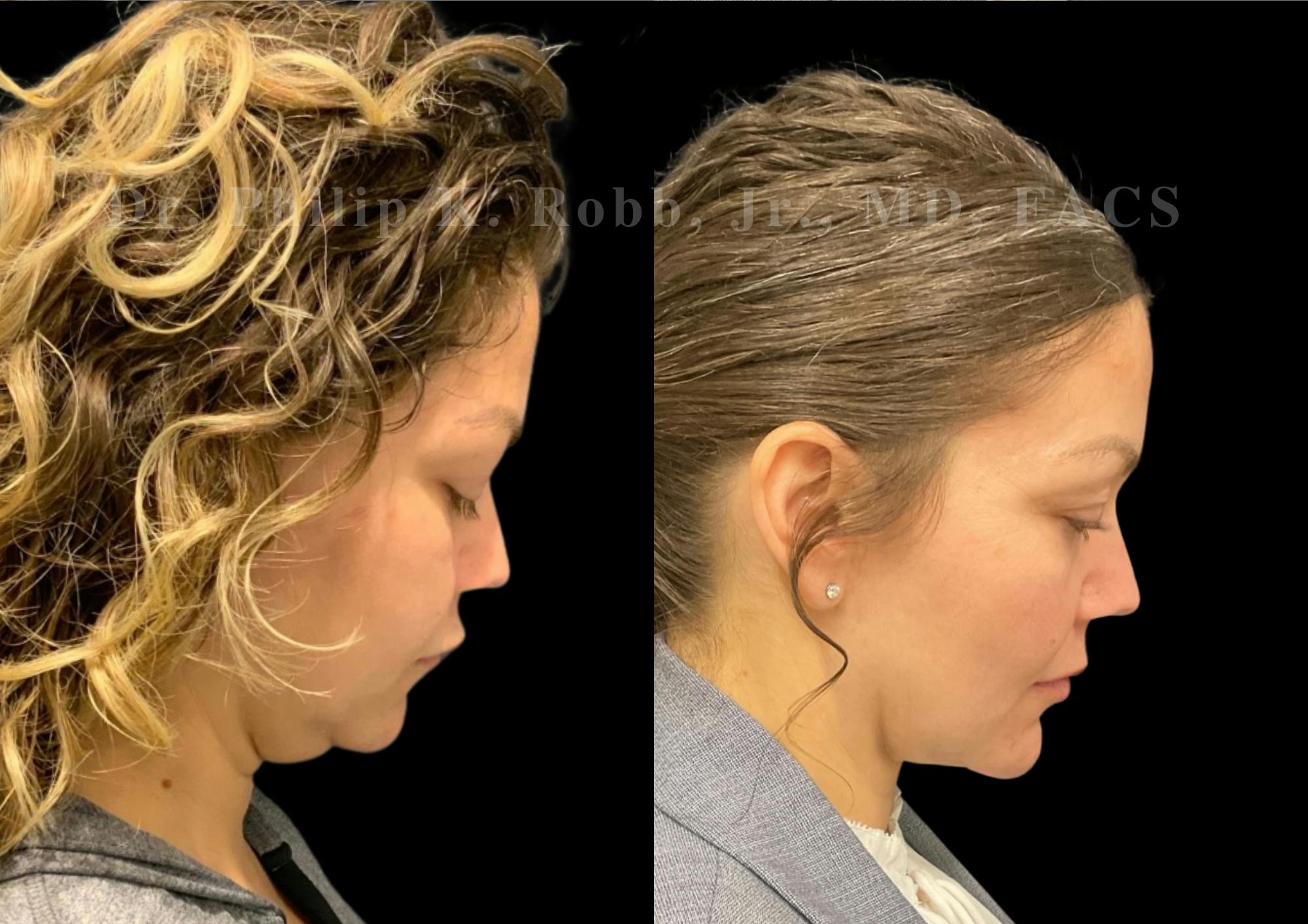 Buccal Fat Reduction Before & After Gallery - Patient 387508 - Image 2