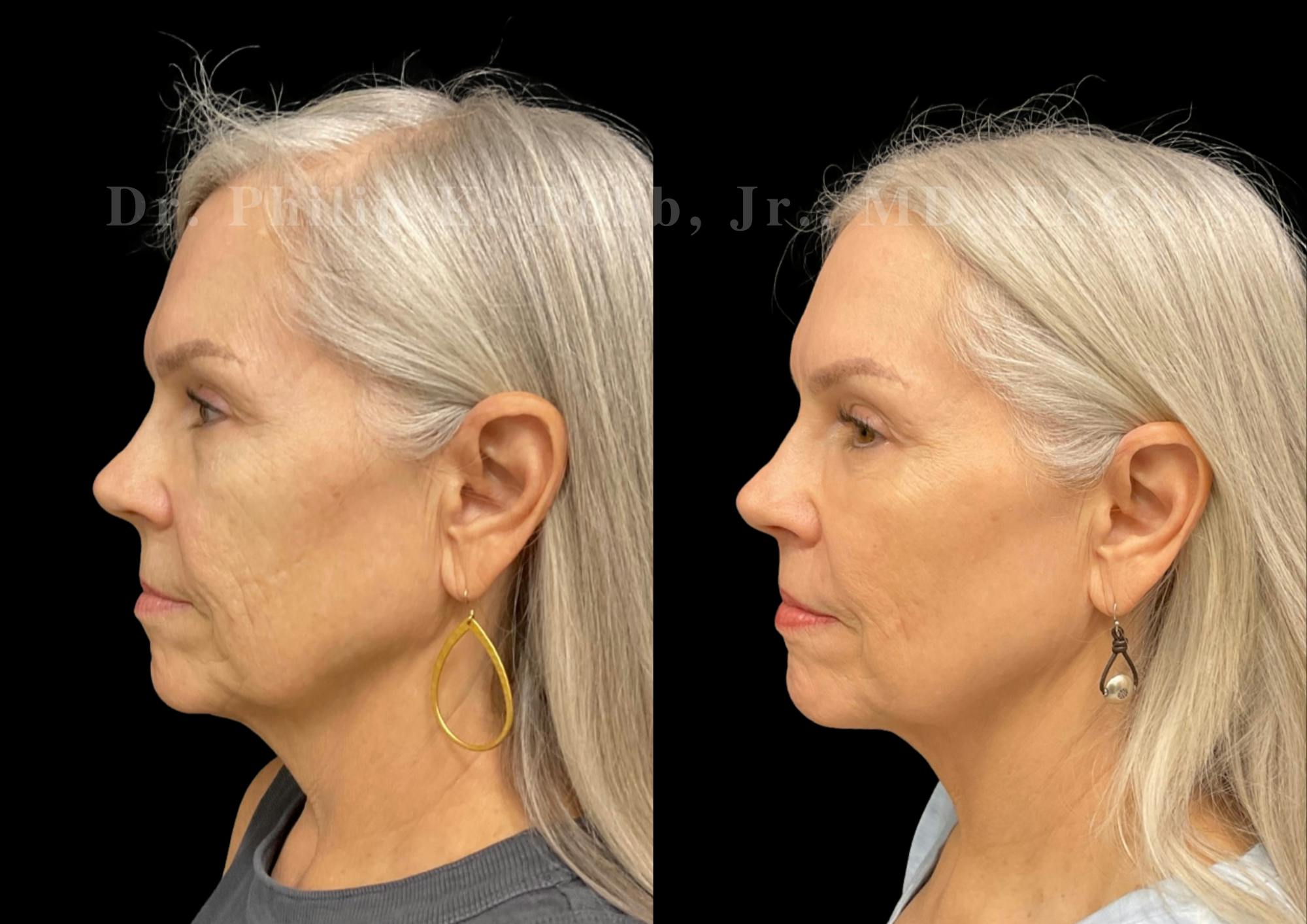 Lower Blepharoplasty Before & After Gallery - Patient 304659 - Image 5