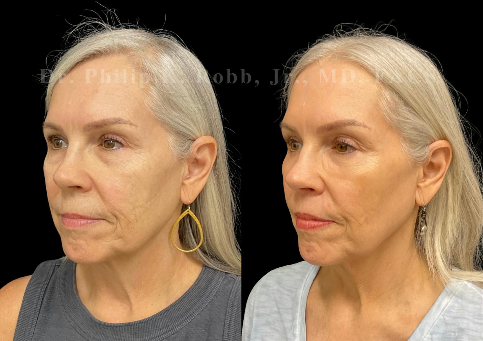 Lower Blepharoplasty Before & After Gallery - Patient 304659 - Image 4