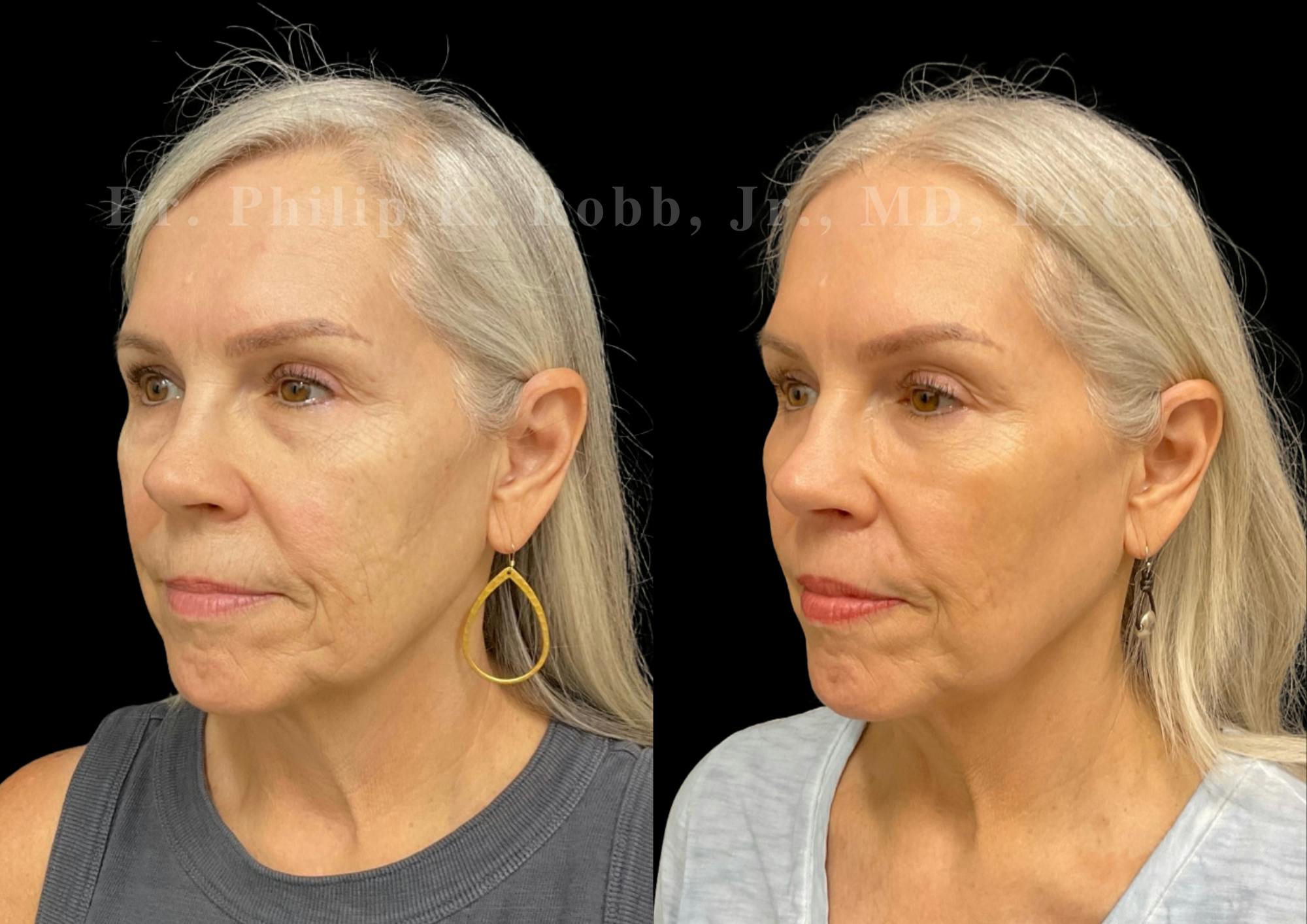 Lip Lift Before & After Gallery - Patient 215827 - Image 2