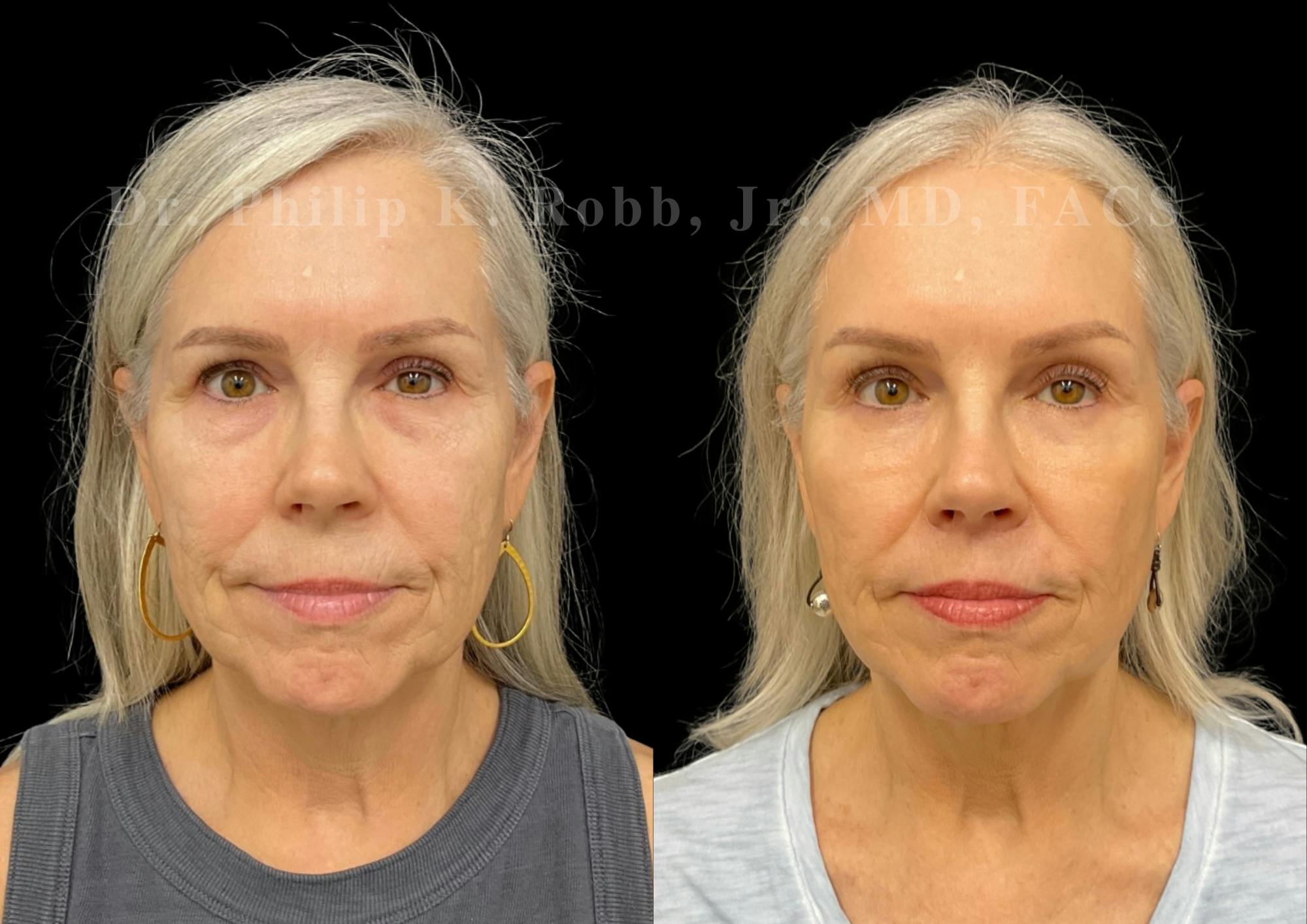 Fat Transfer Before & After Gallery - Patient 344279 - Image 1
