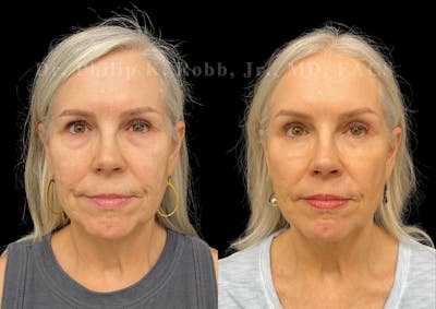 Buccal Fat Reduction Before & After Gallery - Patient 345229 - Image 1