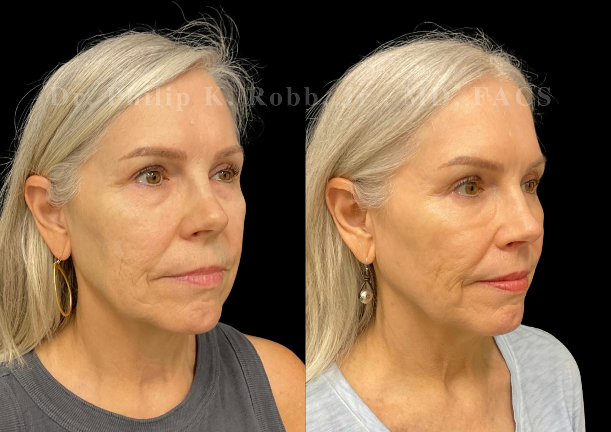 Lip Lift Before & After Gallery - Patient 215827 - Image 4