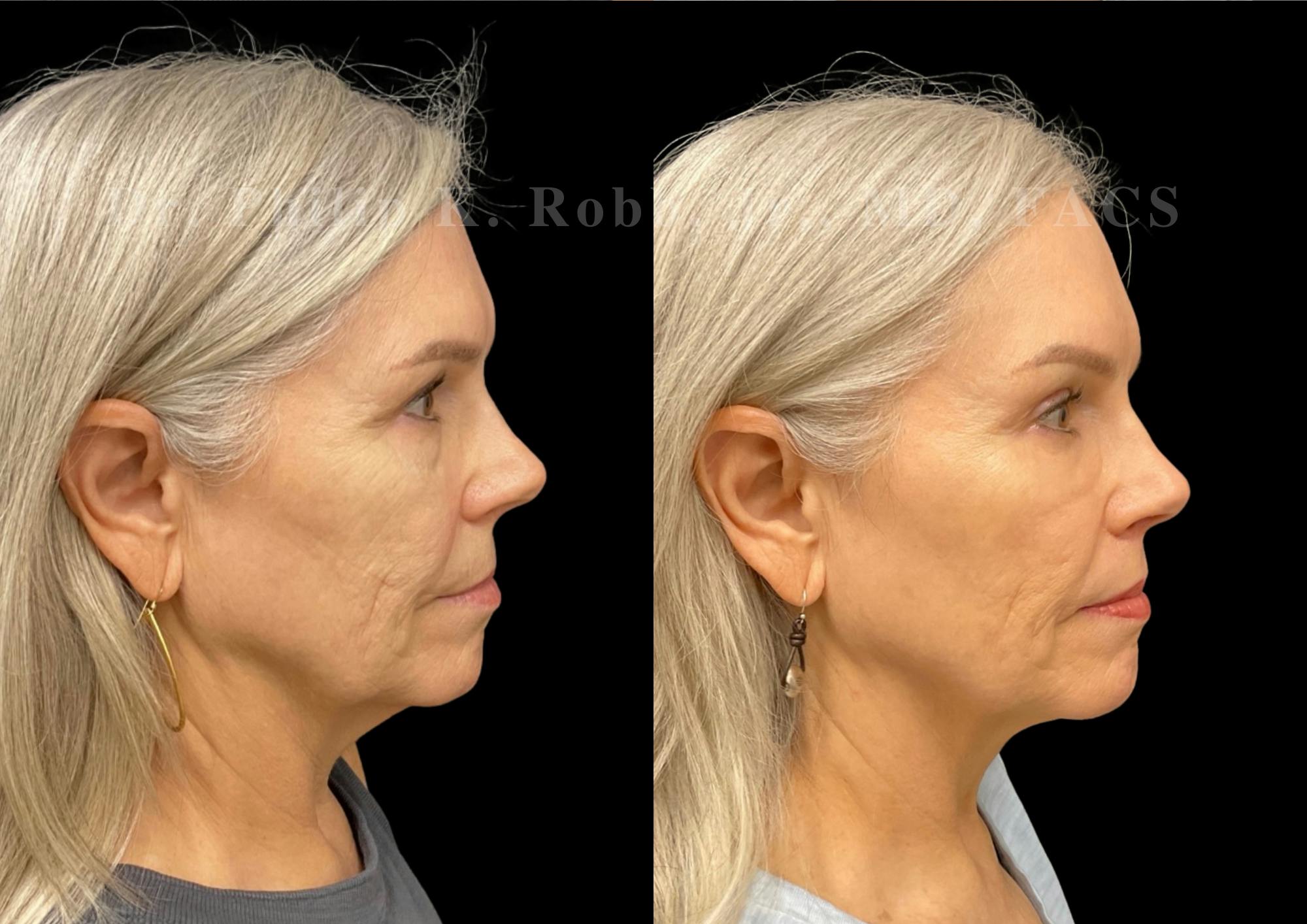 Laser Skin Resurfacing Before & After Gallery - Patient 215150 - Image 2