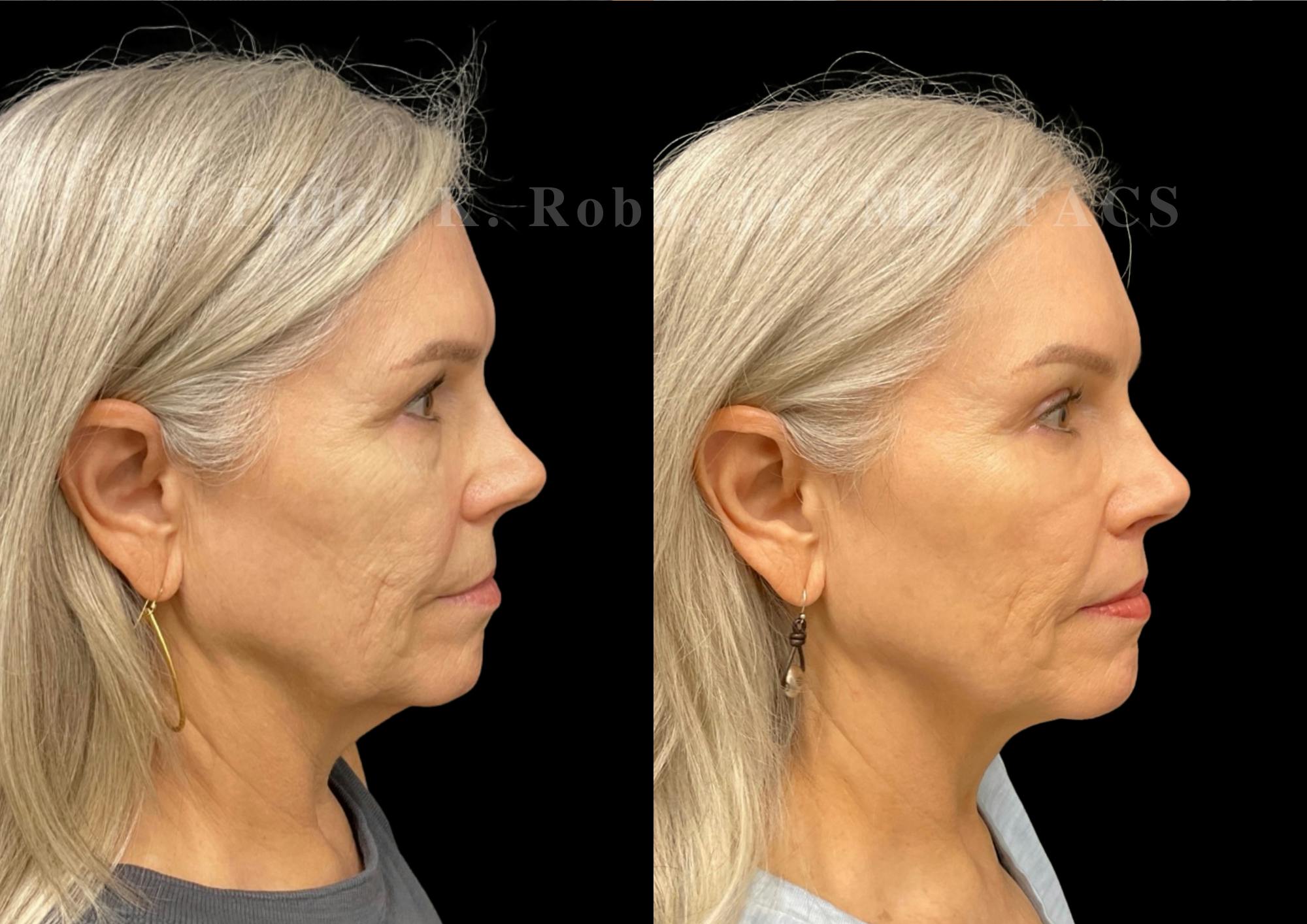 Lip Lift Before & After Gallery - Patient 215827 - Image 5