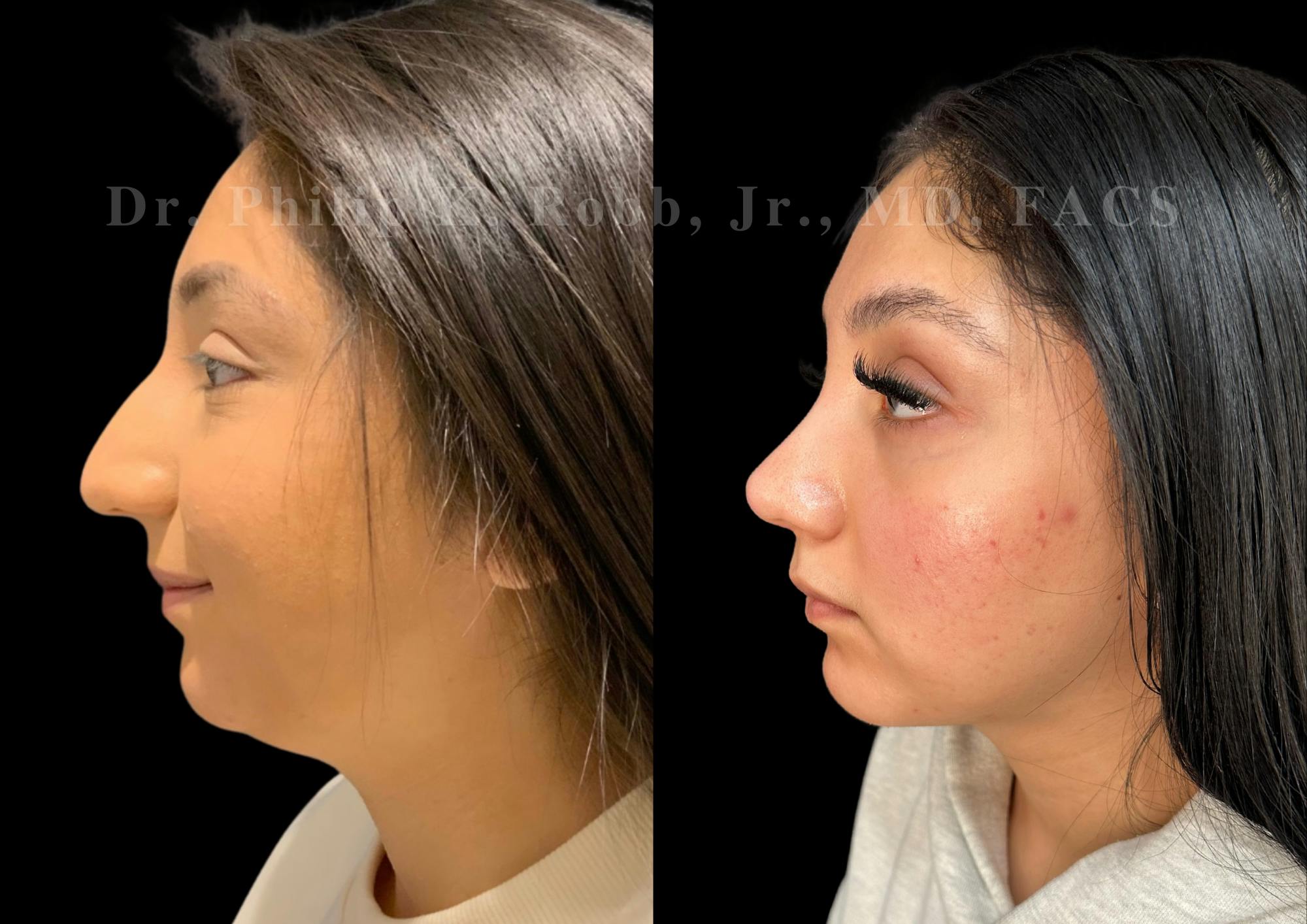 Chin Augmentation Before & After Gallery - Patient 366455 - Image 1