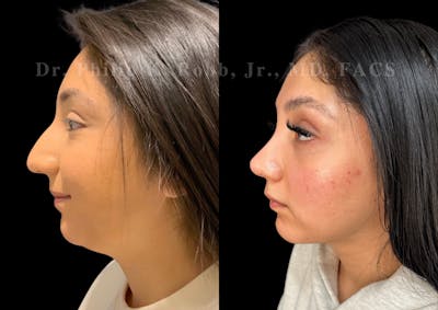 Chin Augmentation Before & After Gallery - Patient 366455 - Image 1