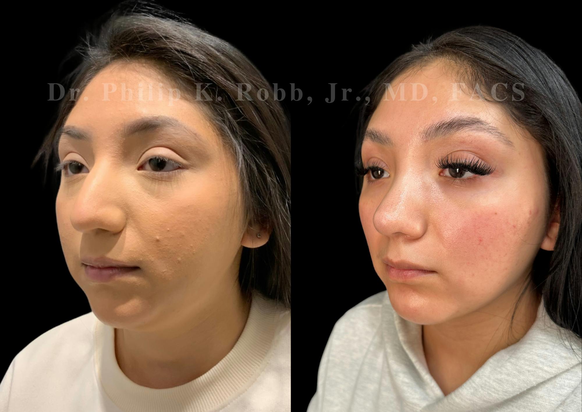 Fat Transfer Before & After Gallery - Patient 293473 - Image 4