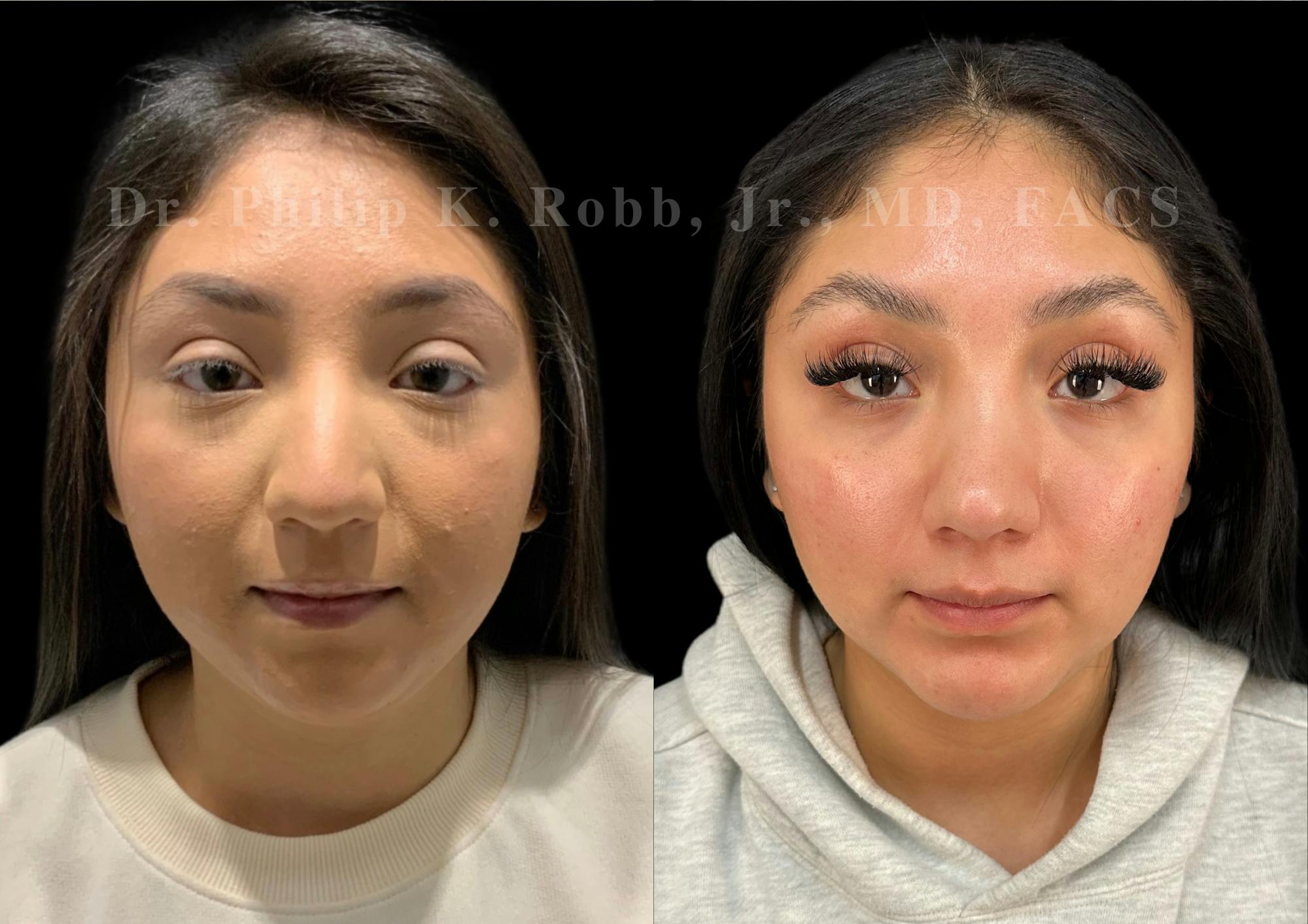 Fat Transfer Before & After Gallery - Patient 293473 - Image 1