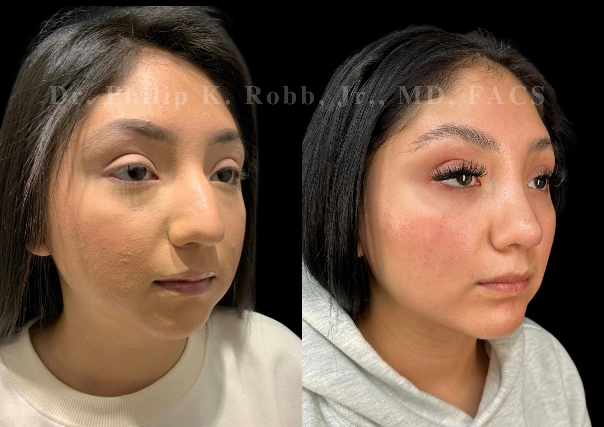 Fat Transfer Before & After Gallery - Patient 293473 - Image 3
