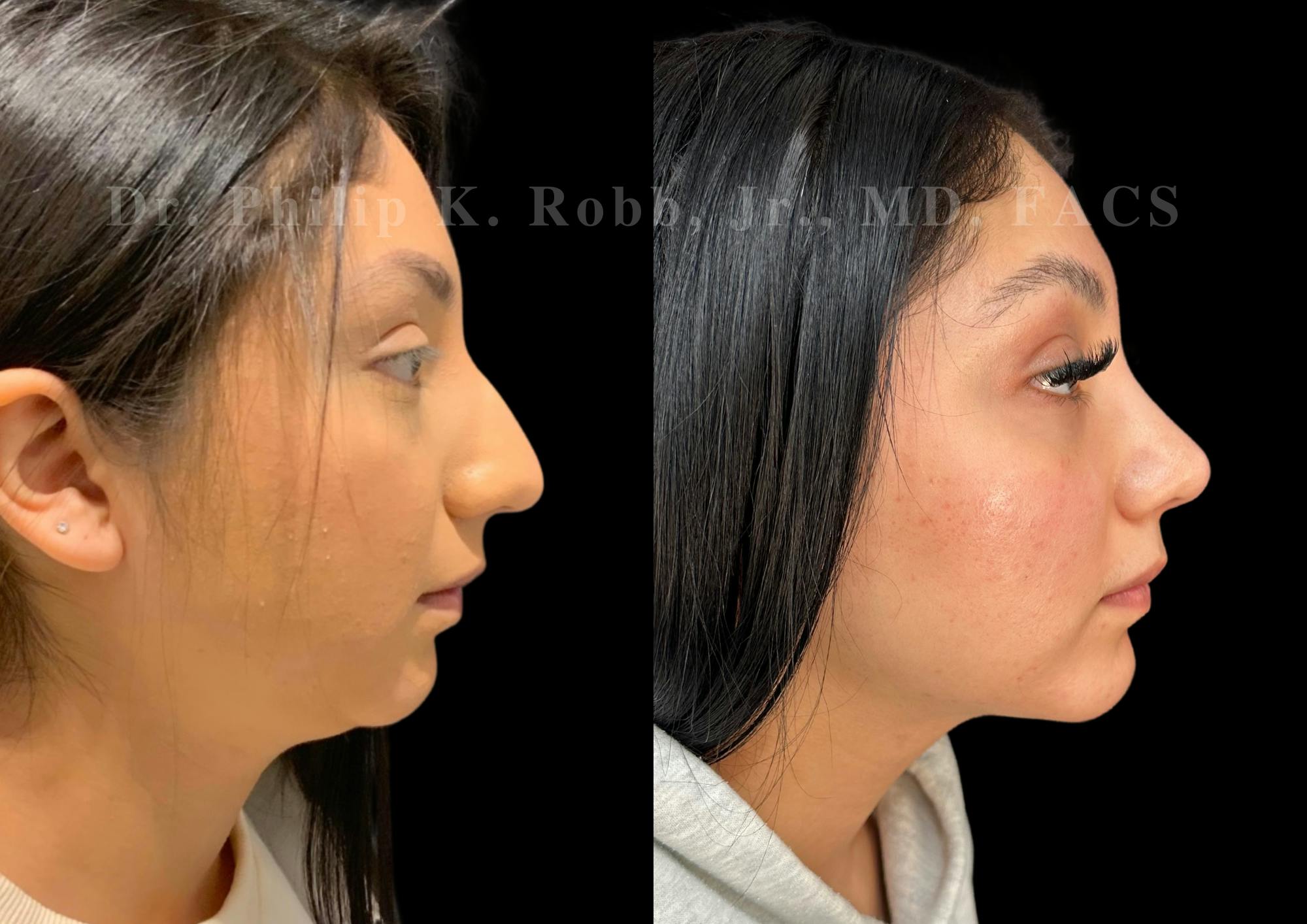 Fat Transfer Before & After Gallery - Patient 293473 - Image 2